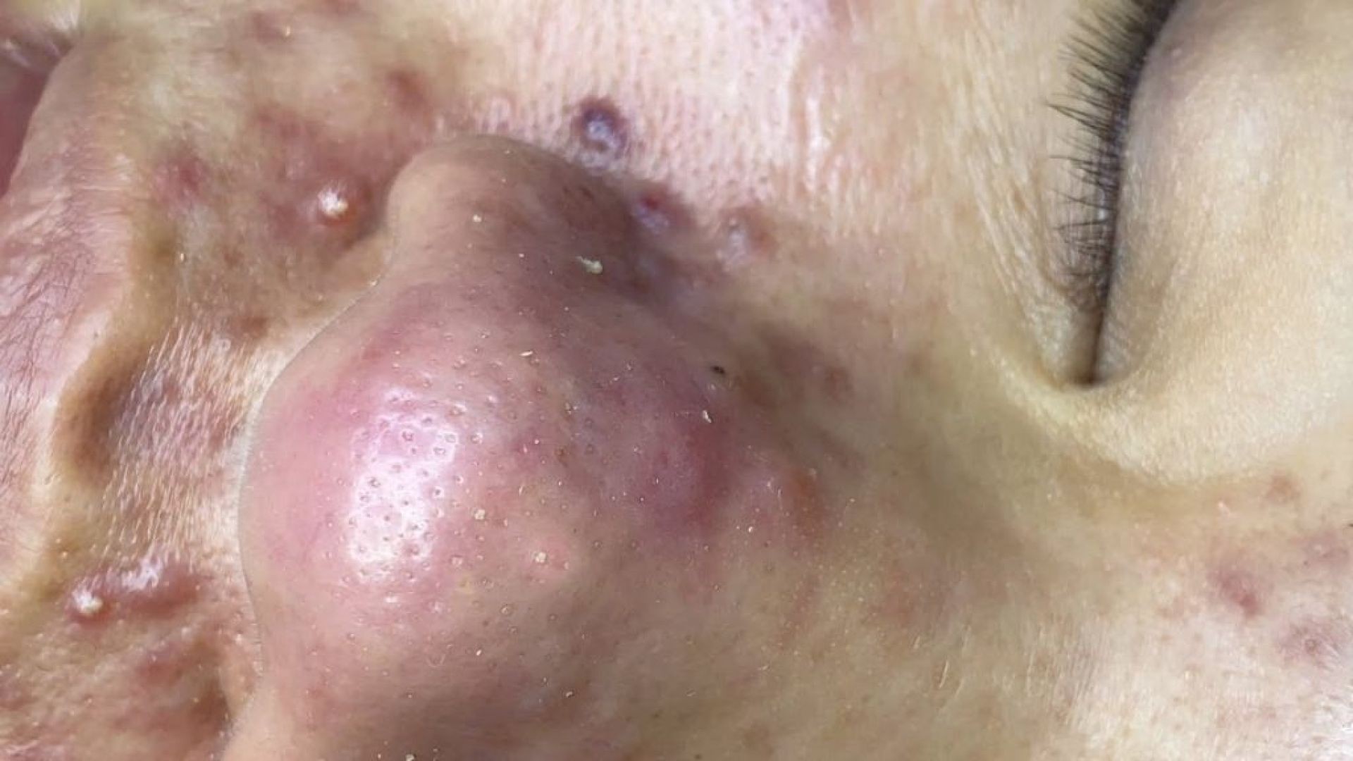Amazing Blackheads Seen in this Video. Just Wait for It!