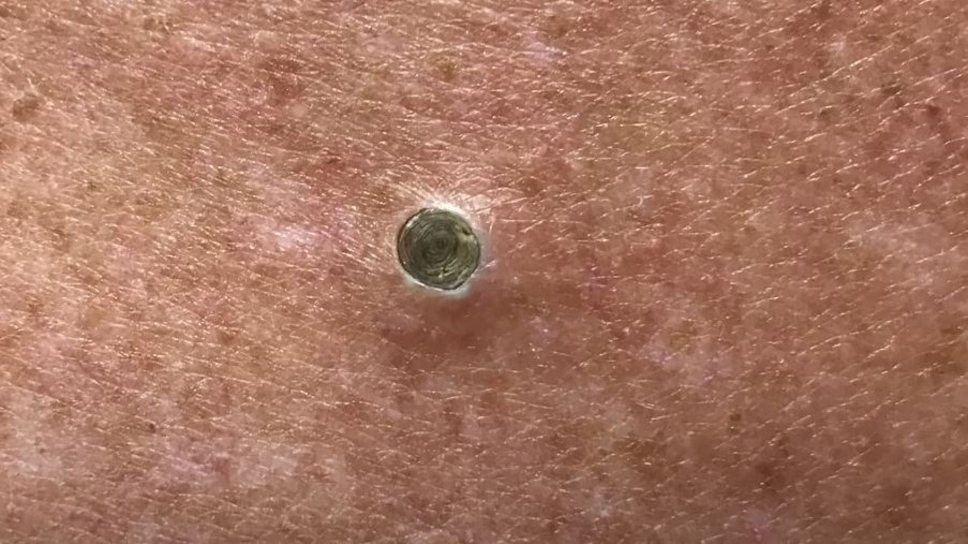The Biggest Dilated Pore of Winer