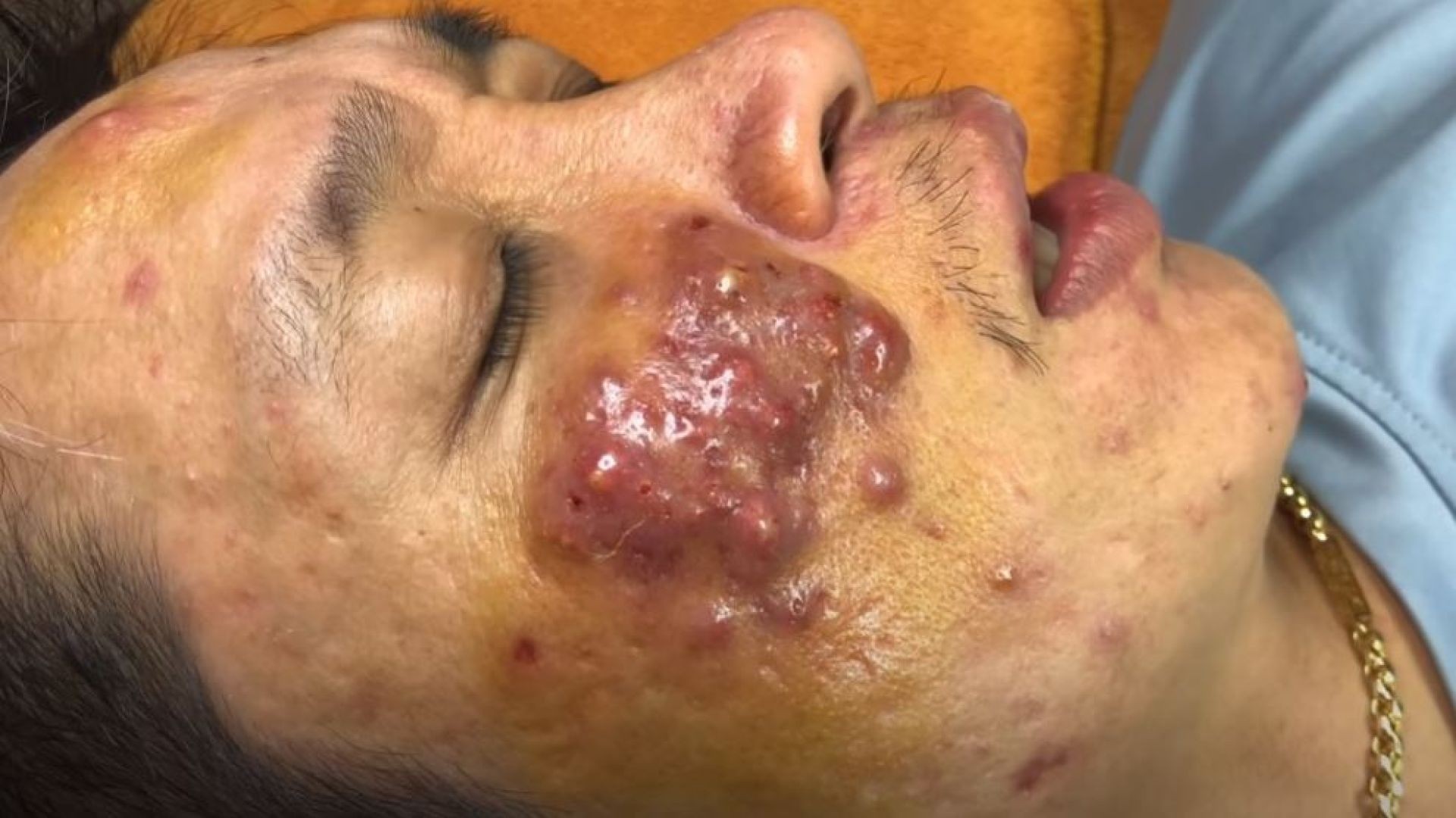 Severe case of inflamed cystic acne popping