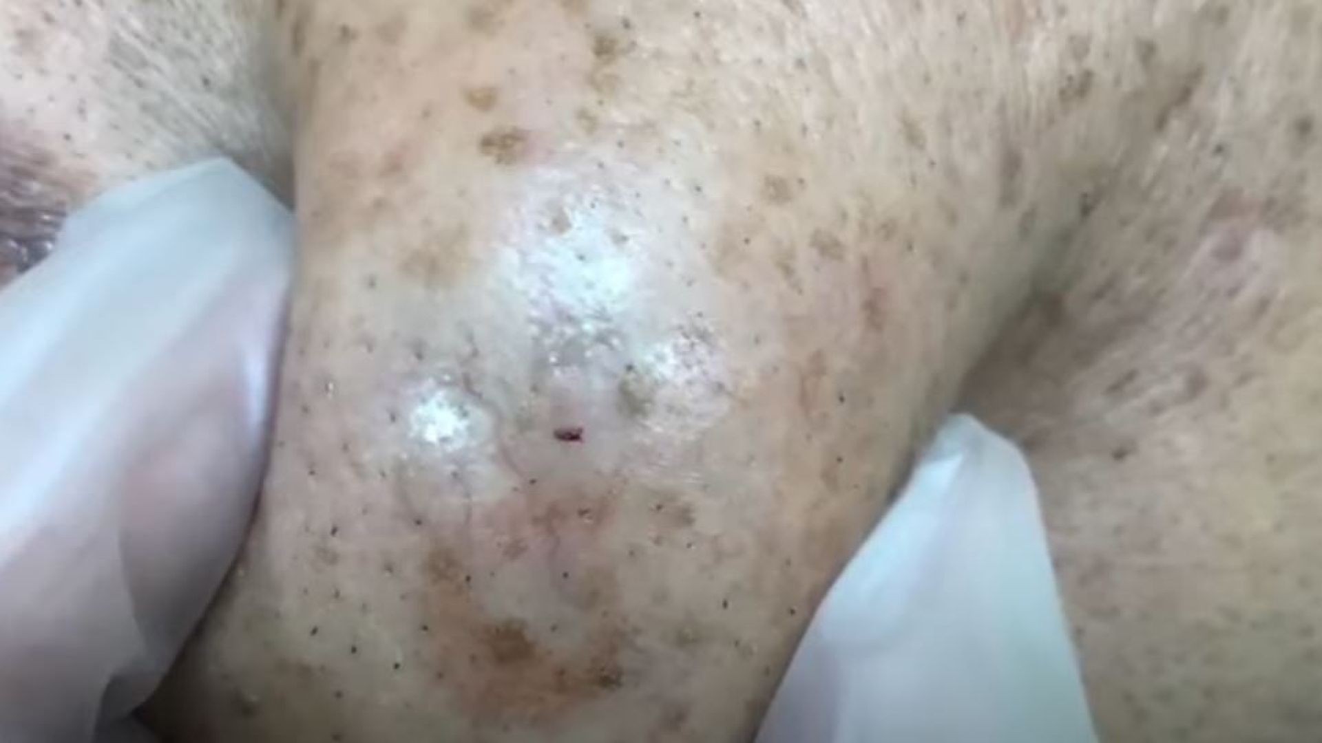 Outstanding Massive Cyst Explosion