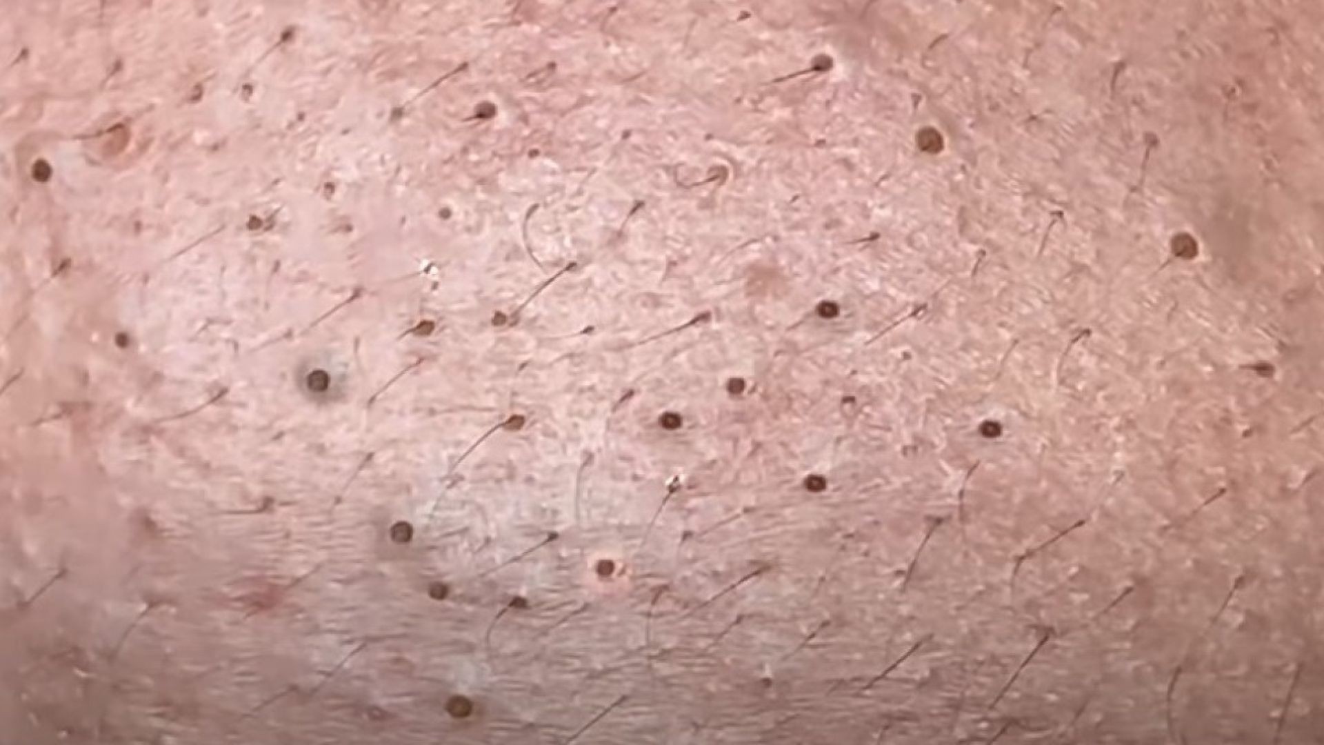 Right Here, the Biggest Blackhead is Popping Out