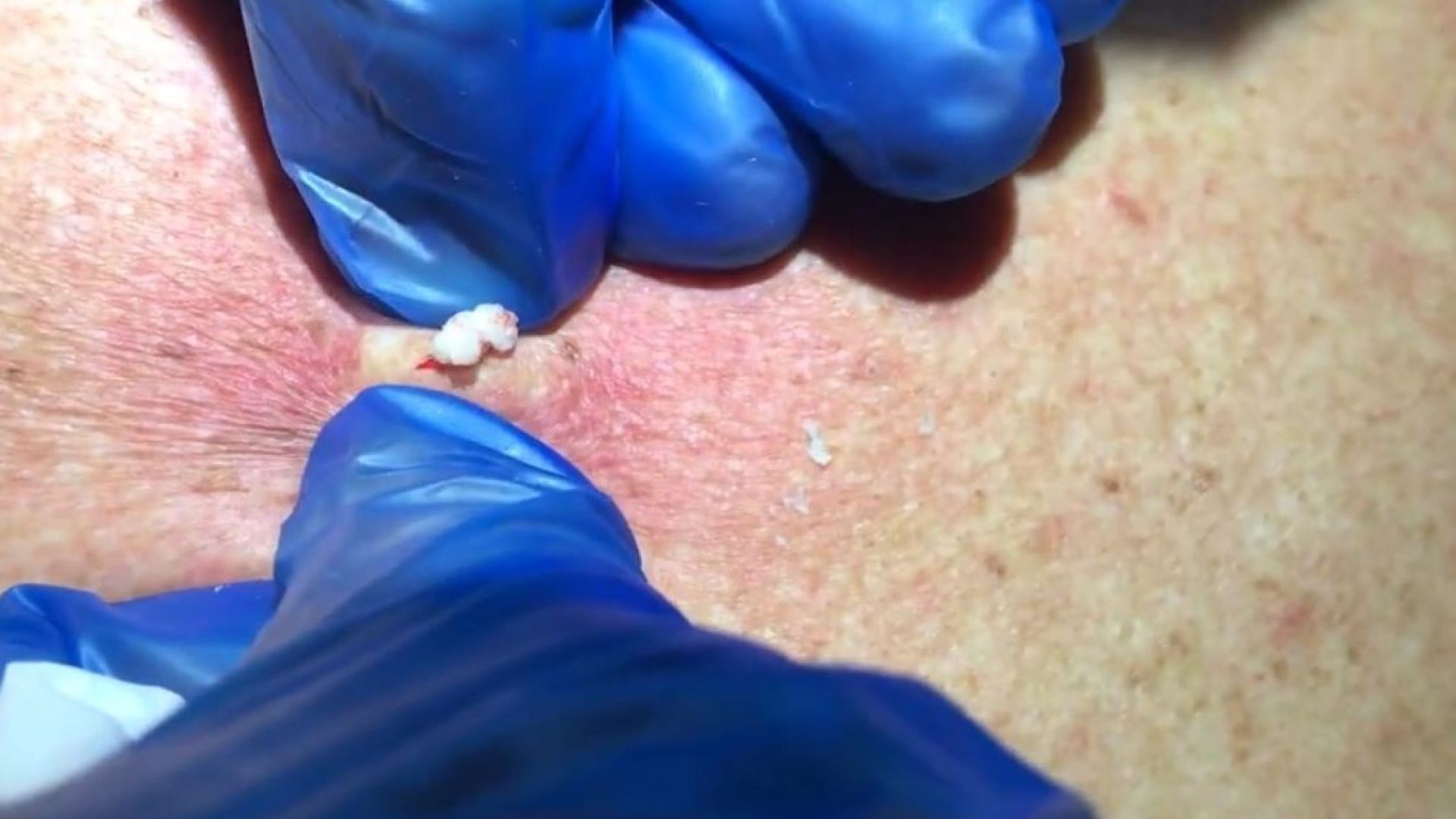 This is the One Cyst Popping Video to see