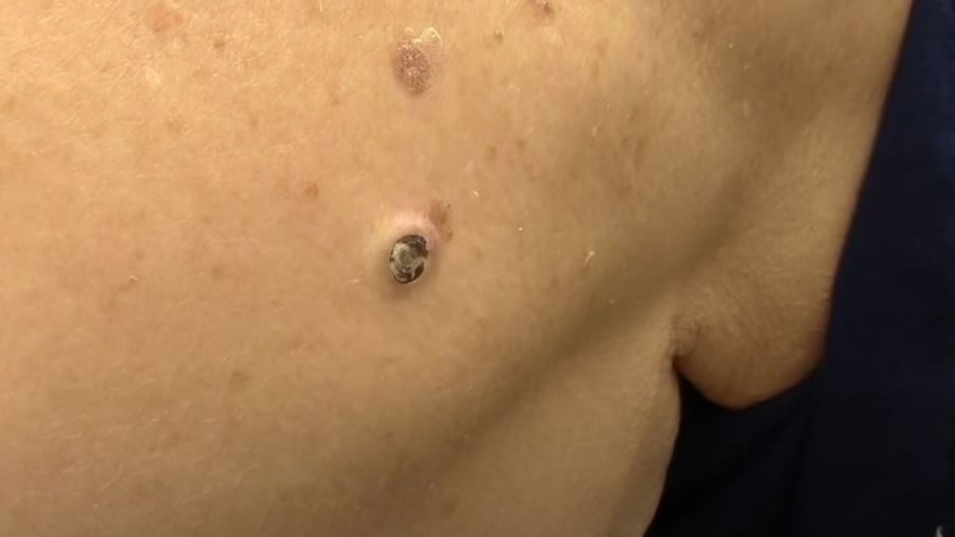 Dilated rock-hard pore of Winer removal