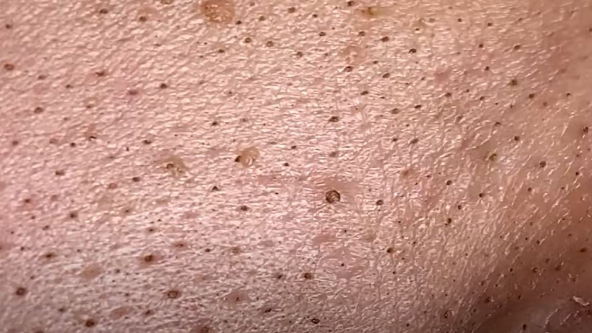 Extreme pimple popping with the ugliest blackheads in history