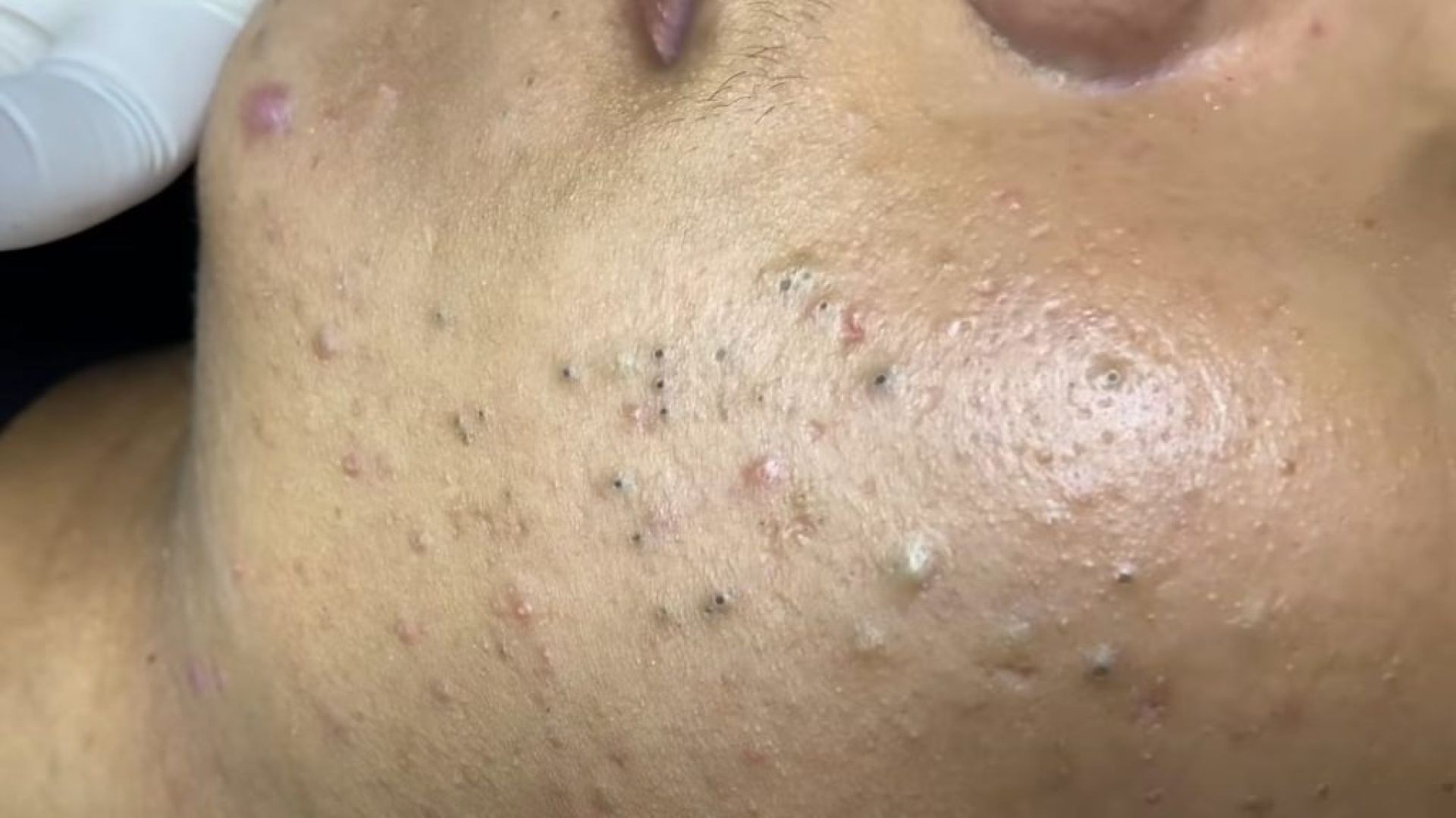 Blackhead Pimple.tv The Best Pimple Popping 2021 Videos You'll Find