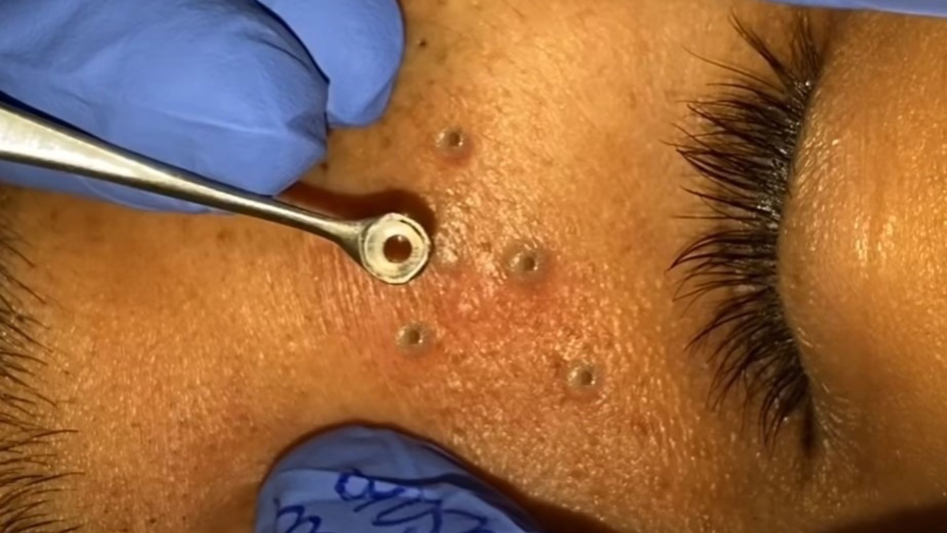 Big blackheads being popped by an UNBELIEVABLE method