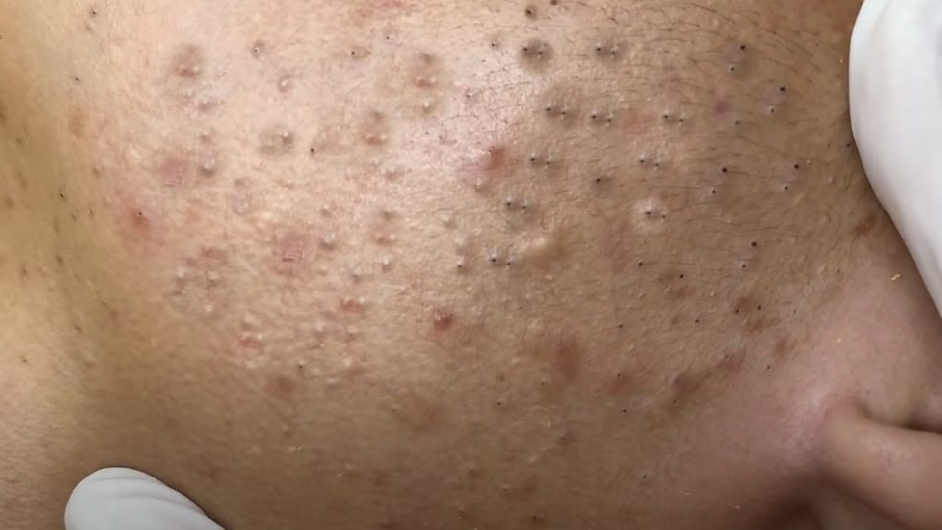 Extreme Blackhead Removal With Non-Stop Popping