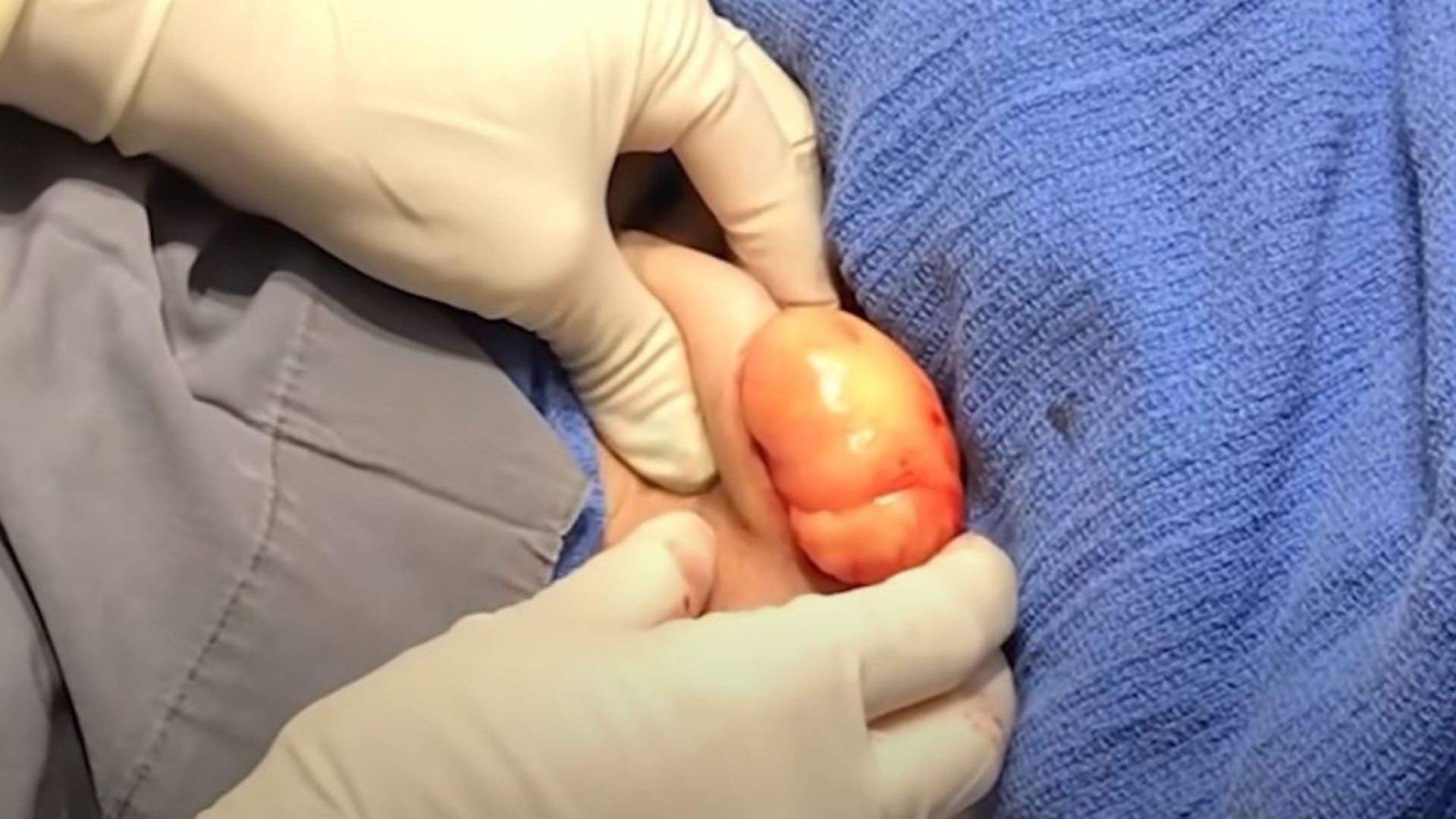 Lipoma Popping After Surgical Cut
