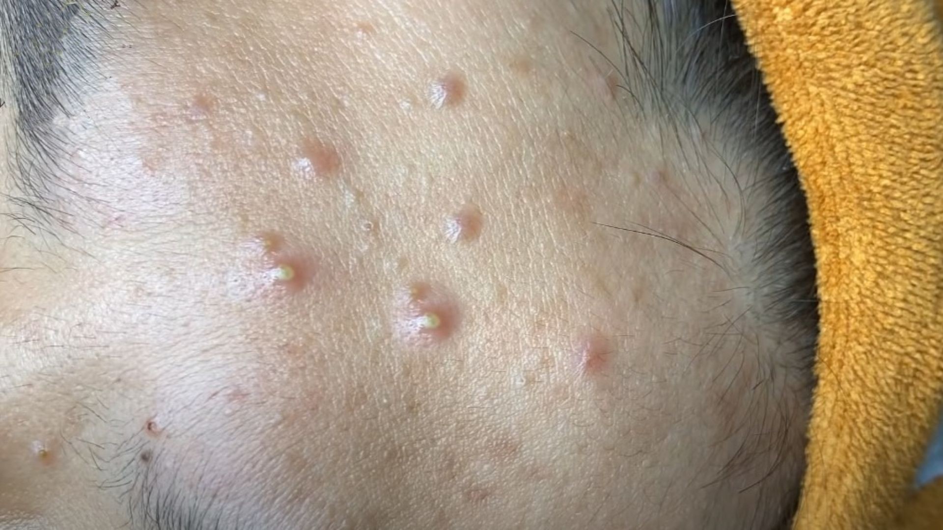 Are You Obsessed With Popping Other People’s Pimples? Then Watch This