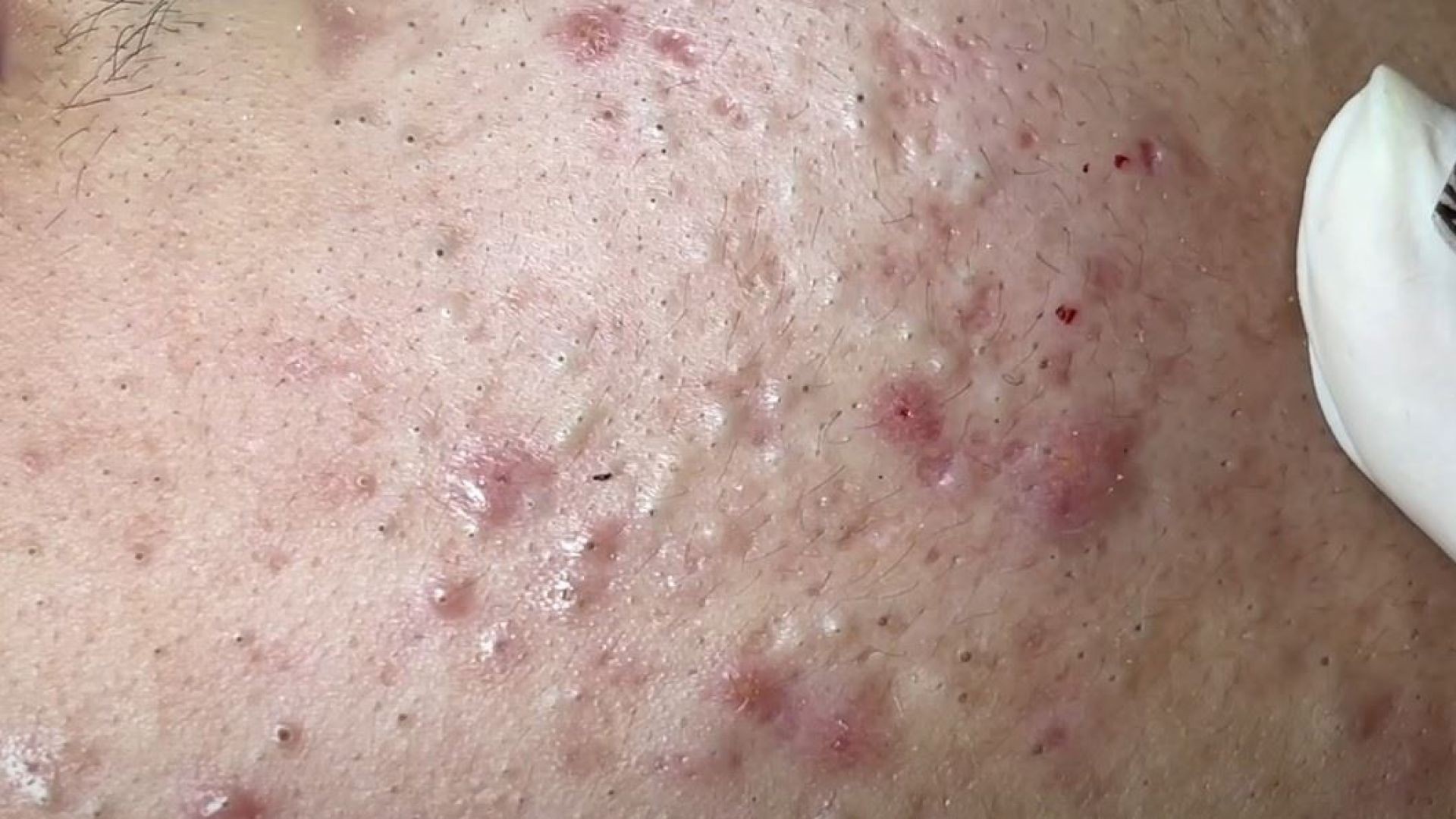 Treatment Of Blackheads And Hidden Acne #036