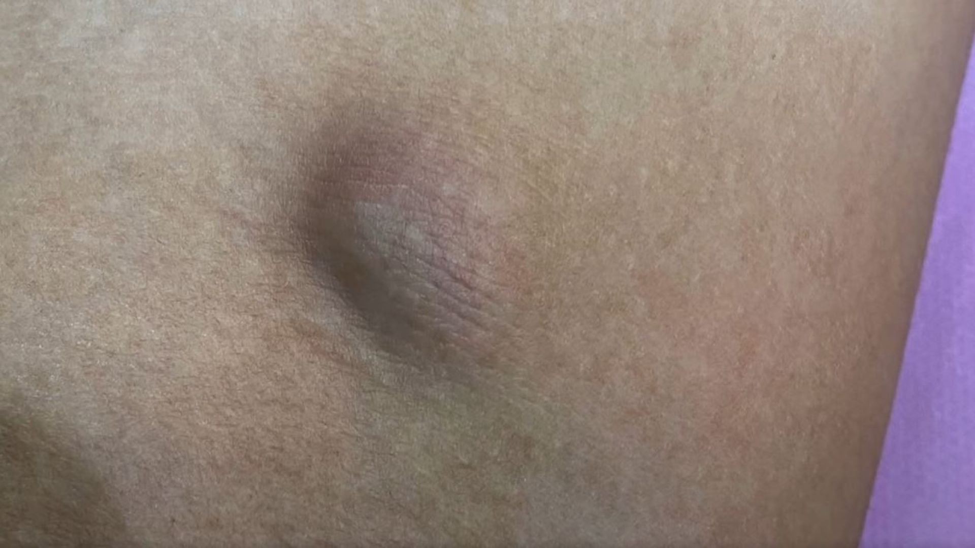 skin tumor, tiny incision