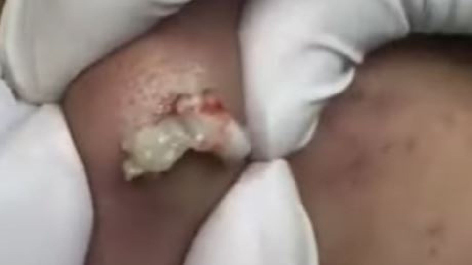 Great cyst popped on face