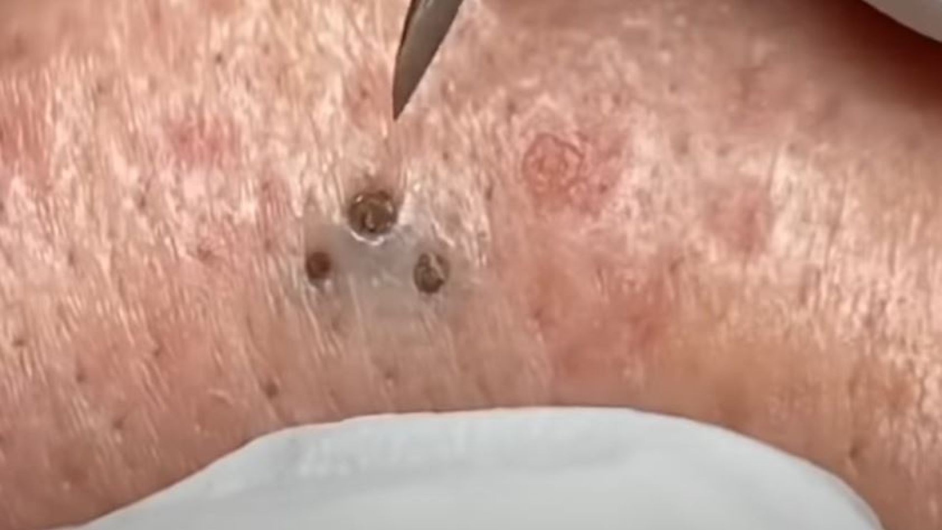 Blackheads extracting with pro tool