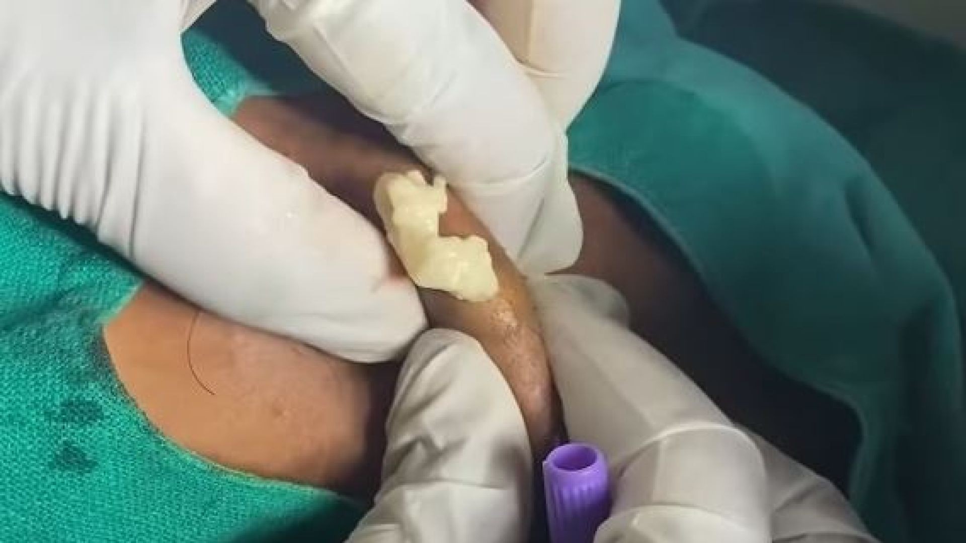 Sebaceous cyst excision using punch technique with out incision dermatosurgeon technique ♥️t