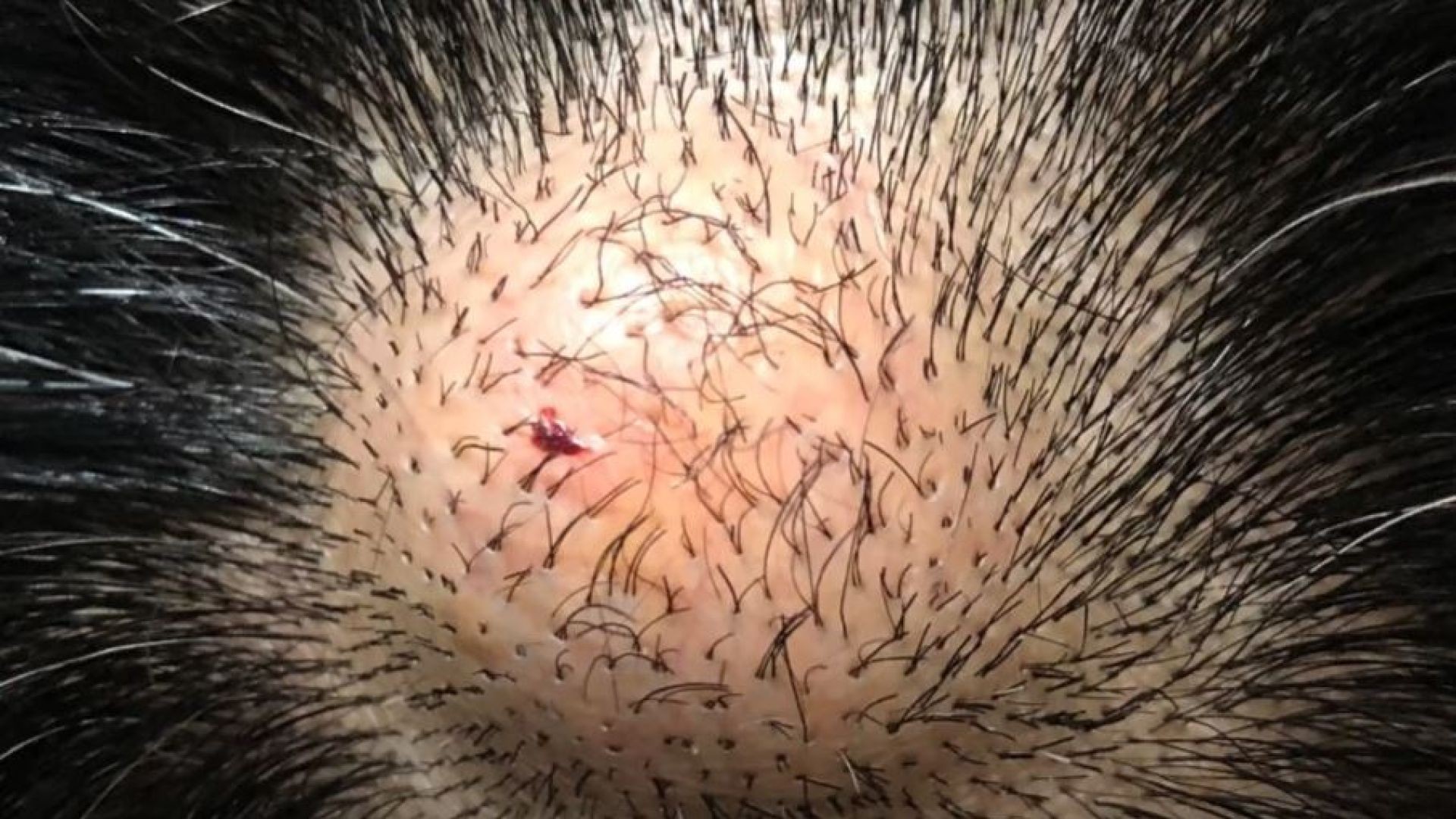 Huge Epidermal Cyst On Scalp Cyst Removal