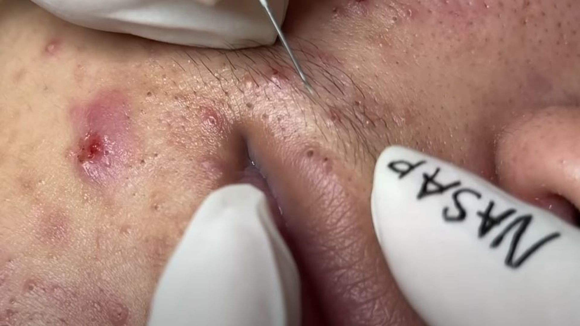 TREATMENT OF BLACKHEADS, HIDDEN ACNE IN THE MOUTH