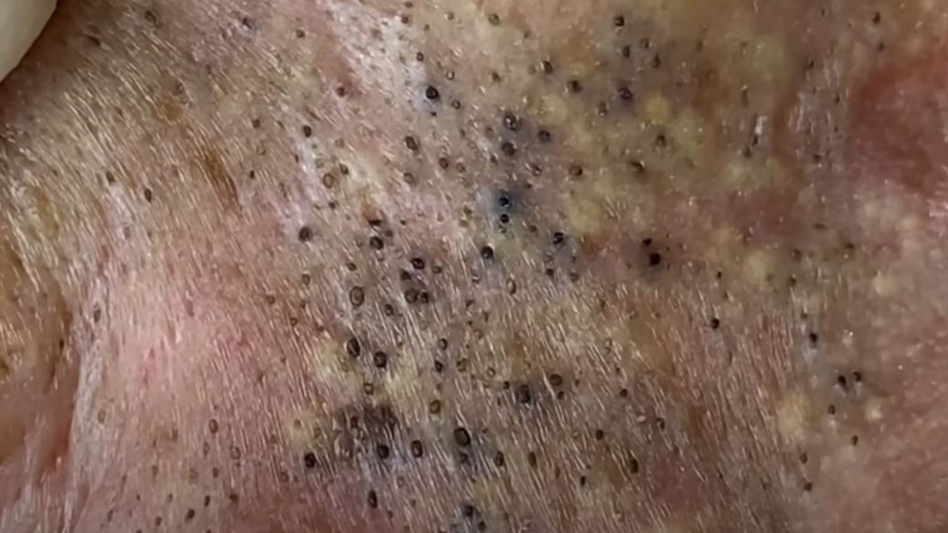 Blackheads Treatment with Loan
