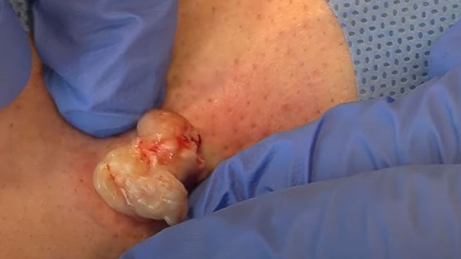 Cyst and Sack Removal | Dr. Derm