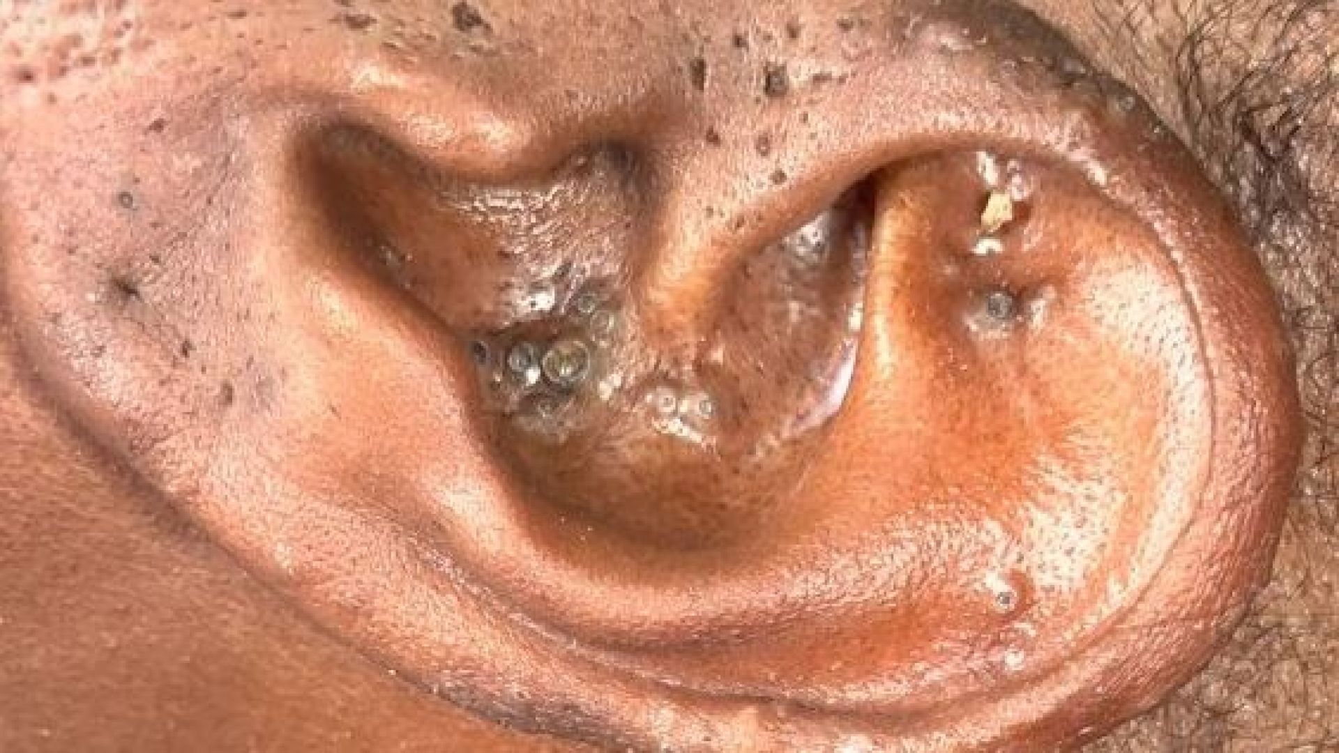 Huge blackheads inside the ear
