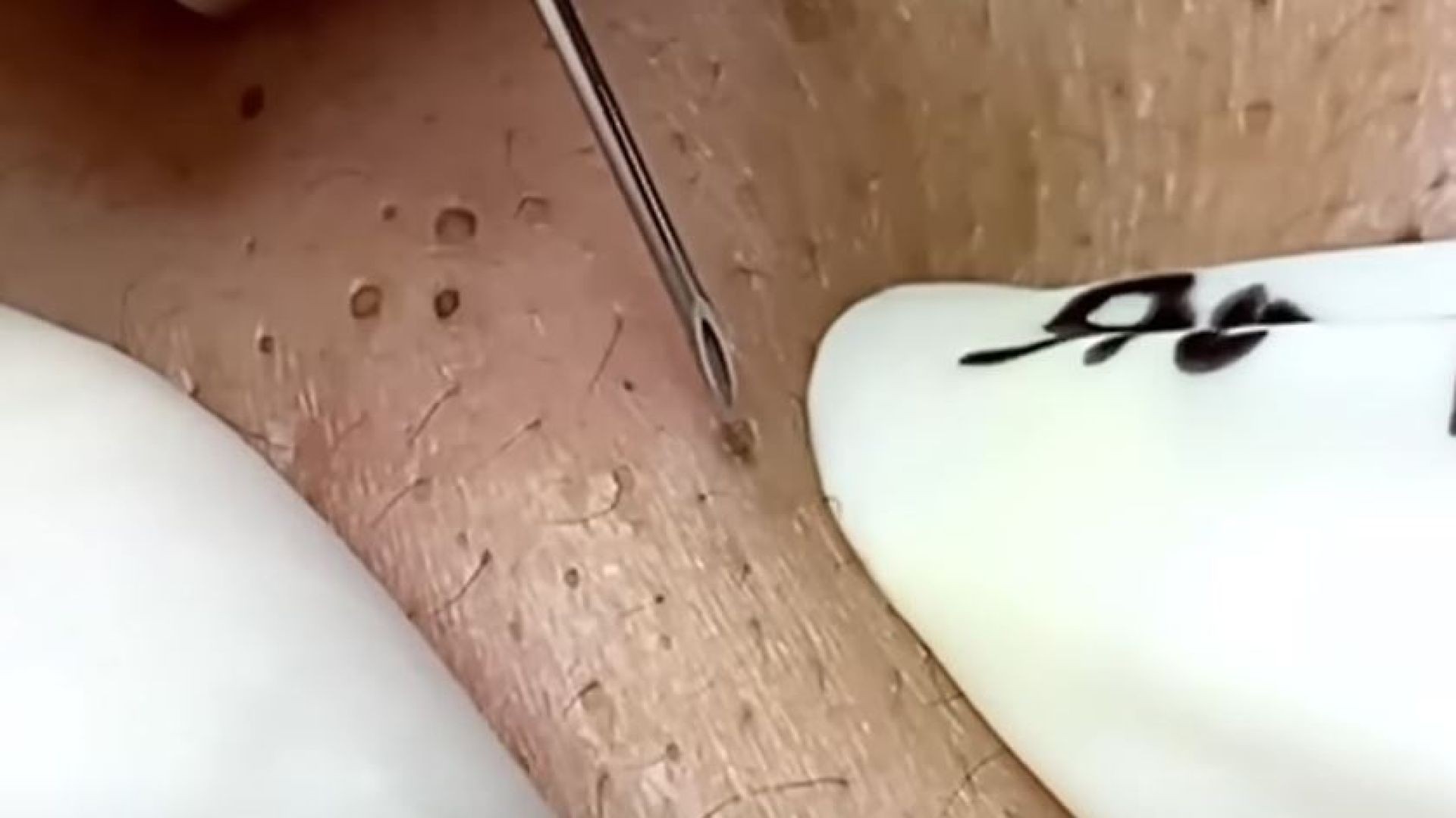 blackheads,pimple 
