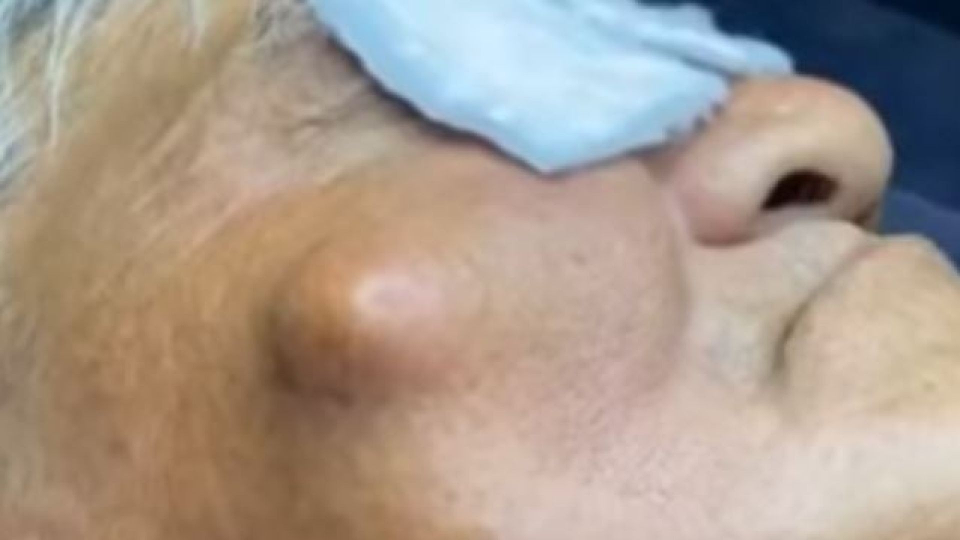 You have to see the size of the cyst on the face! 😮