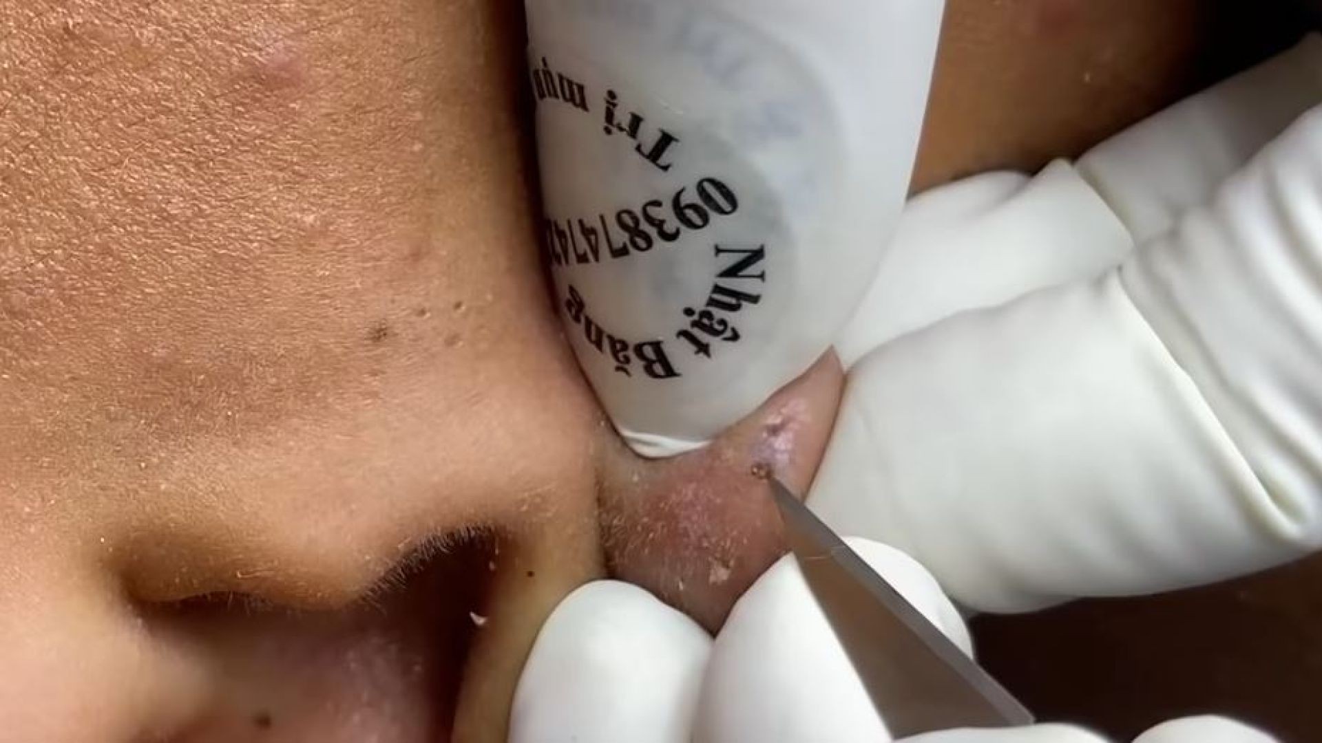 Extreme Close up of Popping Giant Blackheads