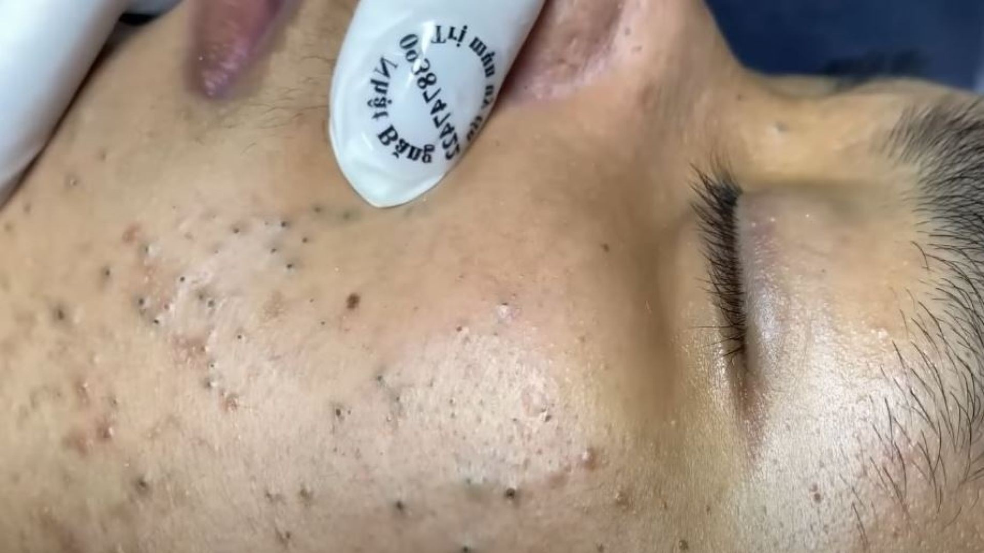 Nose and Face Blackheads