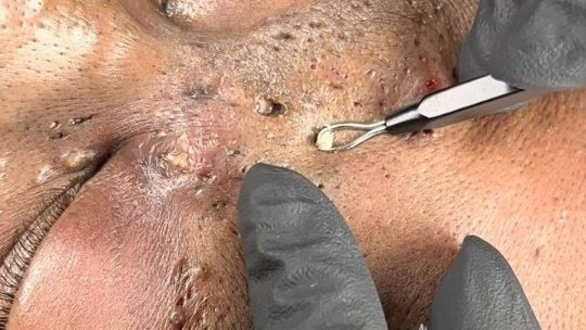 Extraction nevus comedonicus