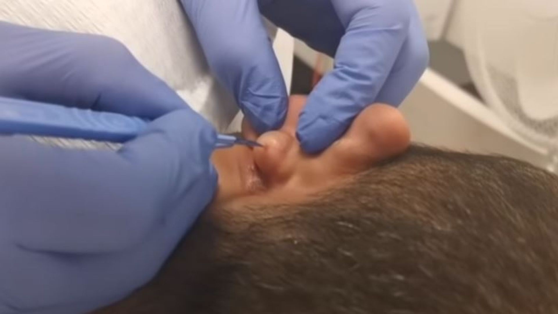 Massive multiple ear cyst Removed. Part 1 of 2