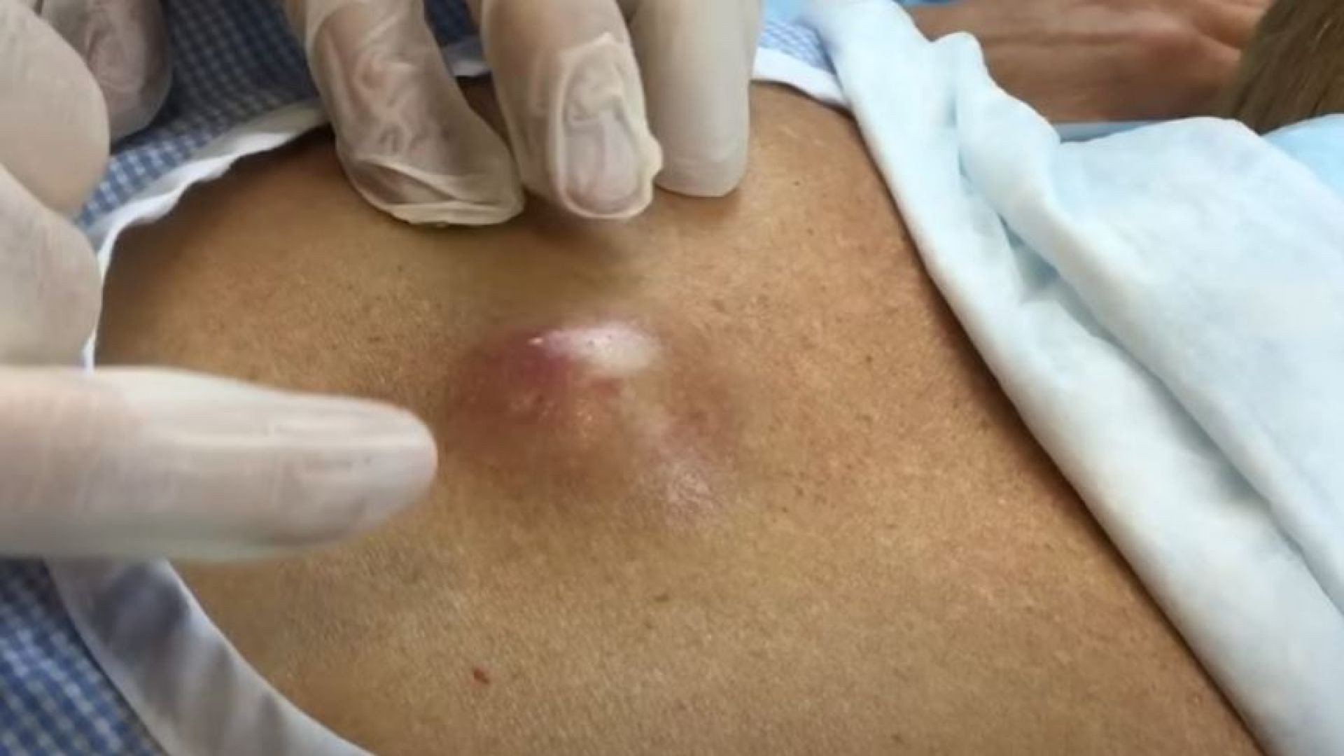 Infected Cyst on Mid-back