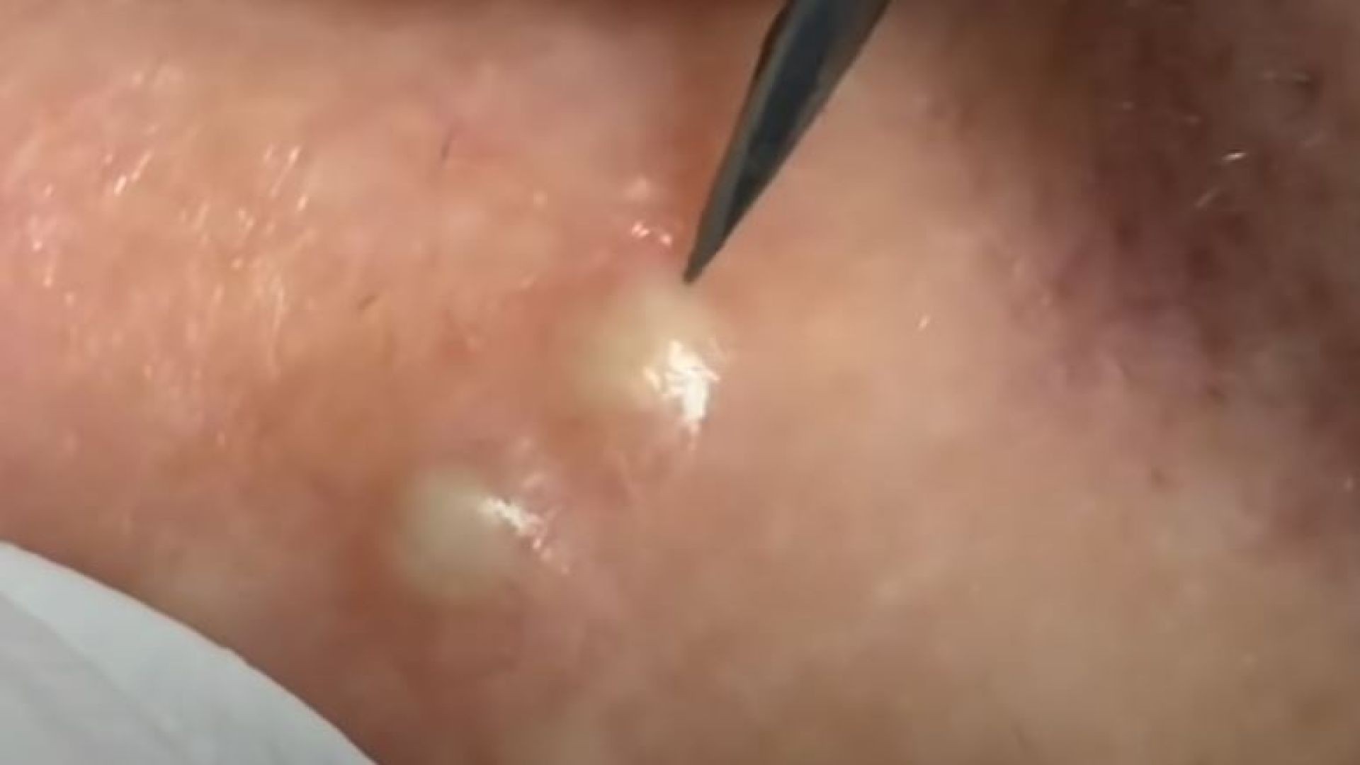 Pimple popping removal