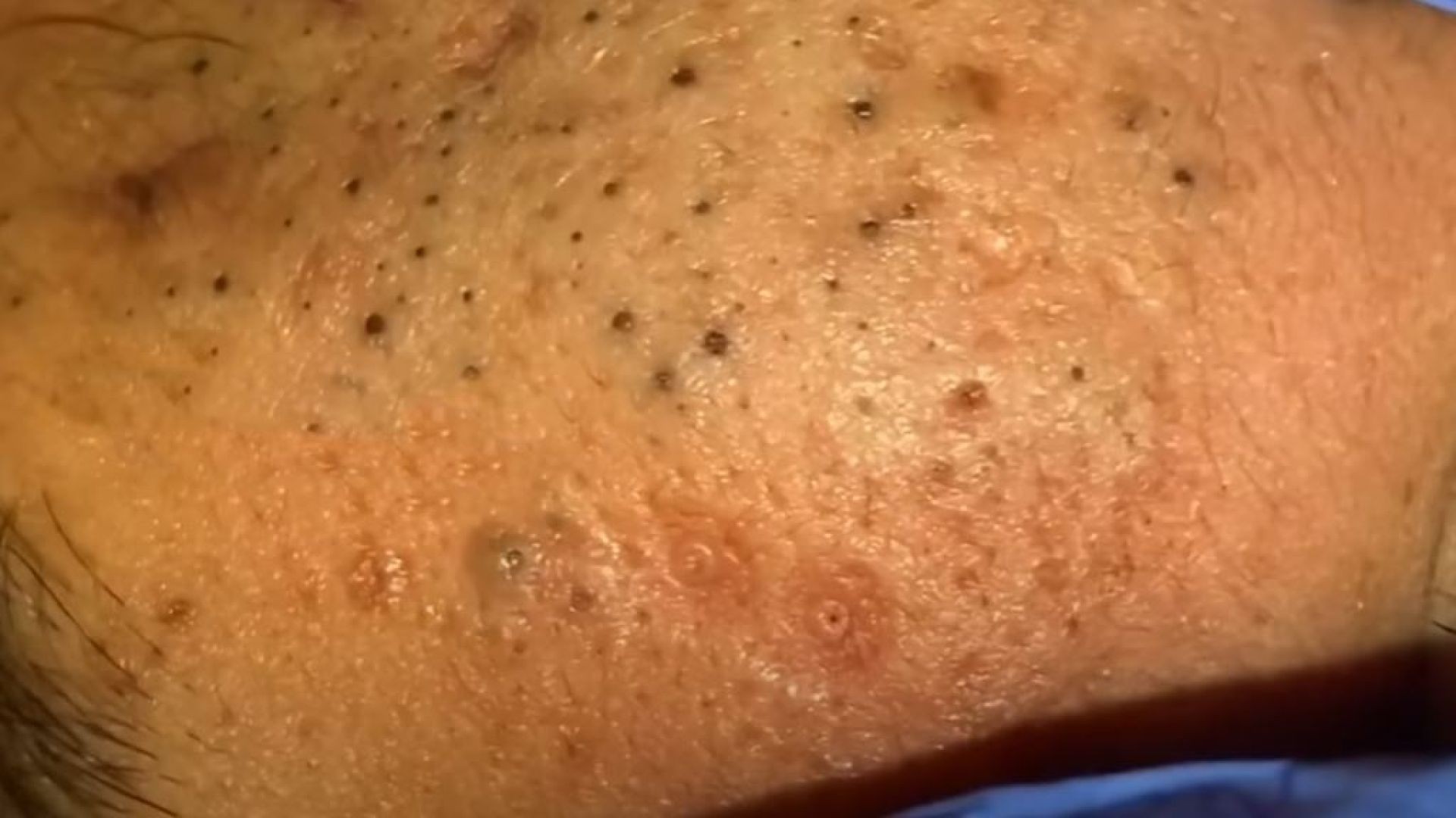Best of Blackheads Removal by Dr Lalit Kasana