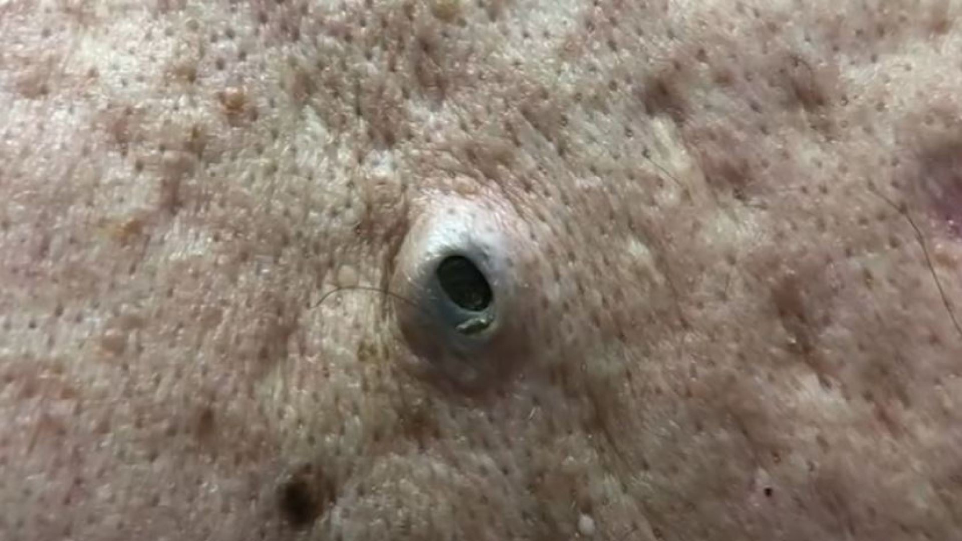 A Dilated Pore of Winer Winner!!