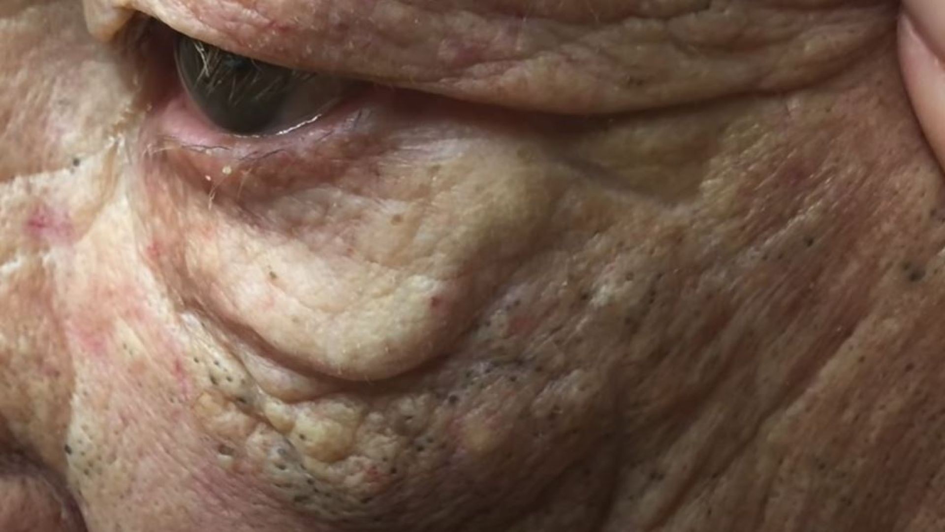 Don't miss these huge blackhead extractions in "The Fireman"