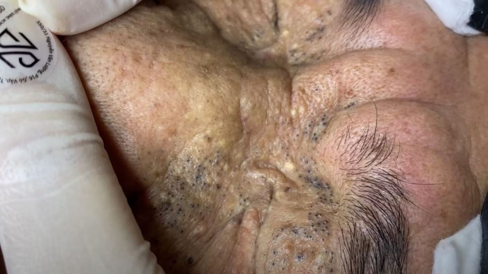 TREATMENT OF BLACKHEADS AND HIDDEN ACNE FOR THE ELDERLY PART 2