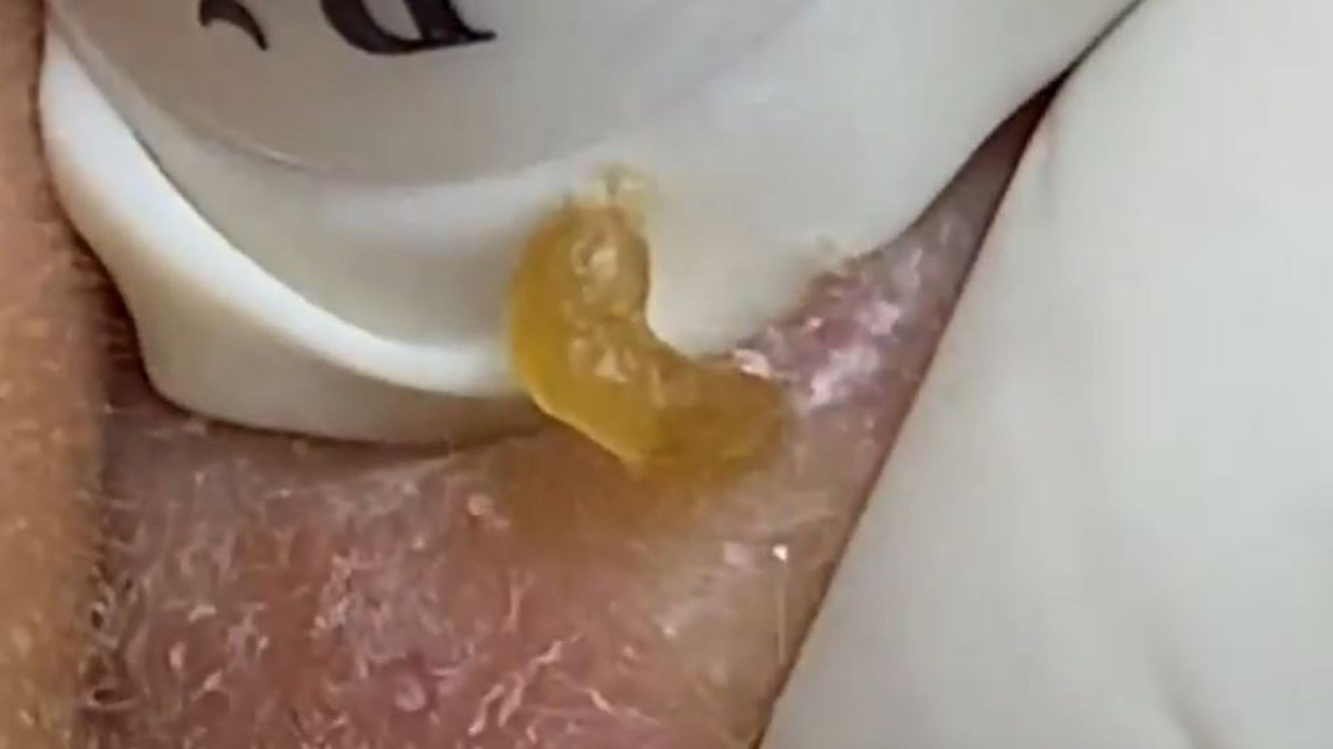 Extreme Close up of Popping Giant Blackheads