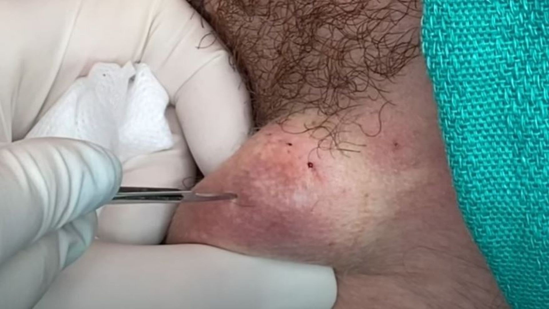 CYST ON NECK