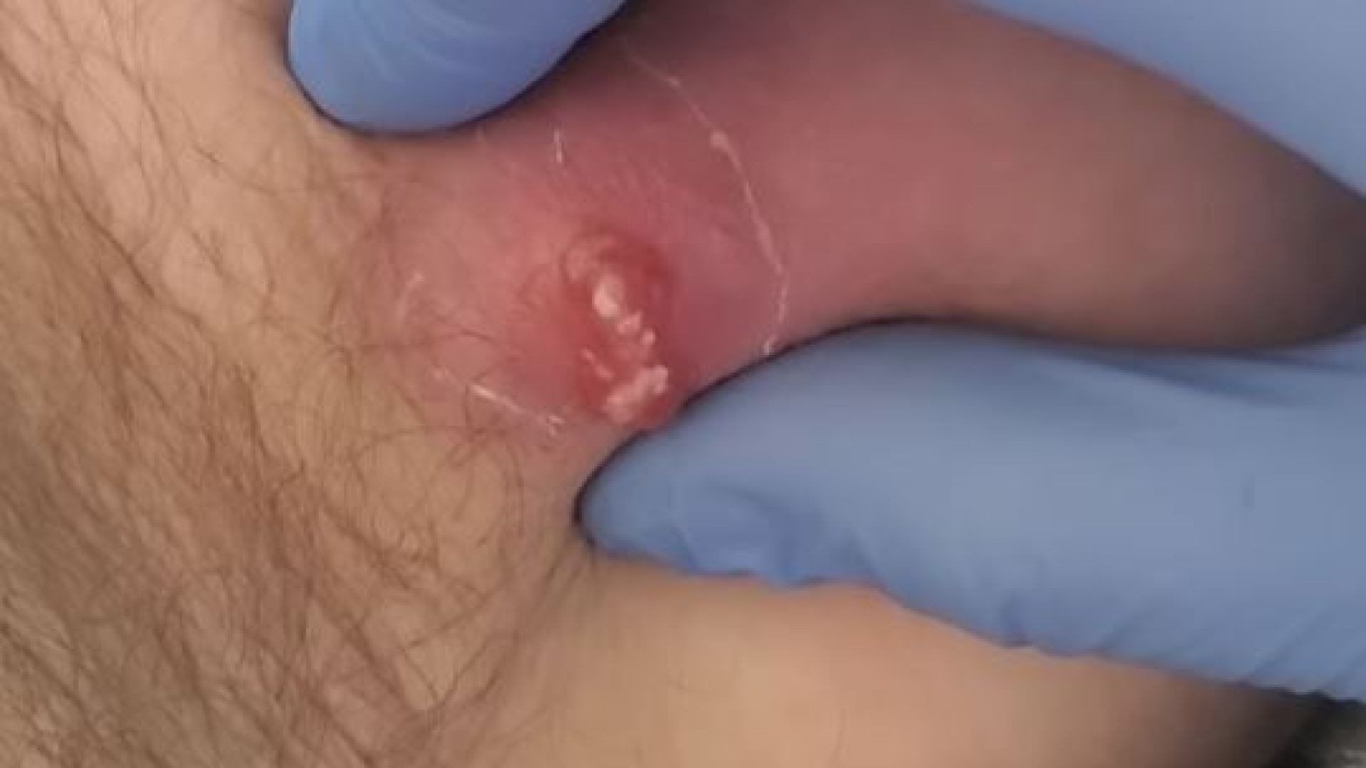 Cysts inner thigh. ingrown hair cyst removal won't