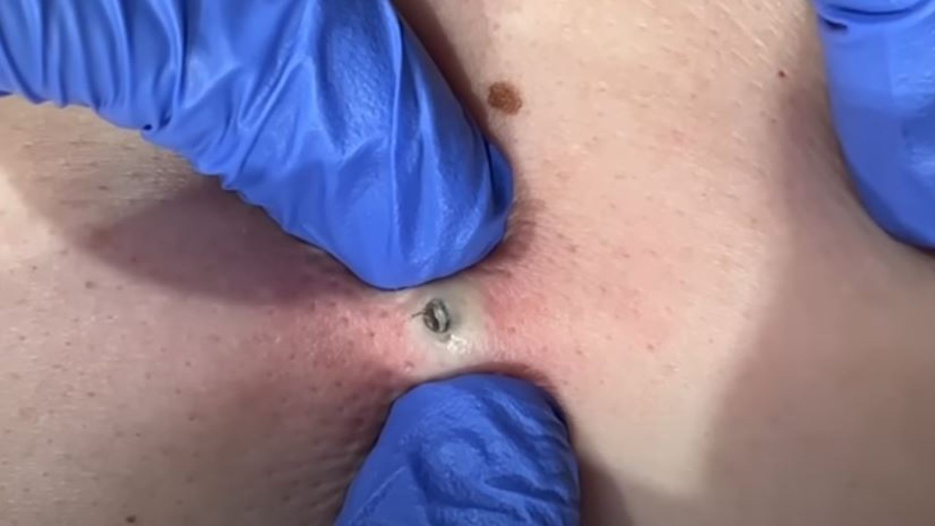 Spazieren gehen anwendung ihre pimple bursts bevorzugen gummi wette