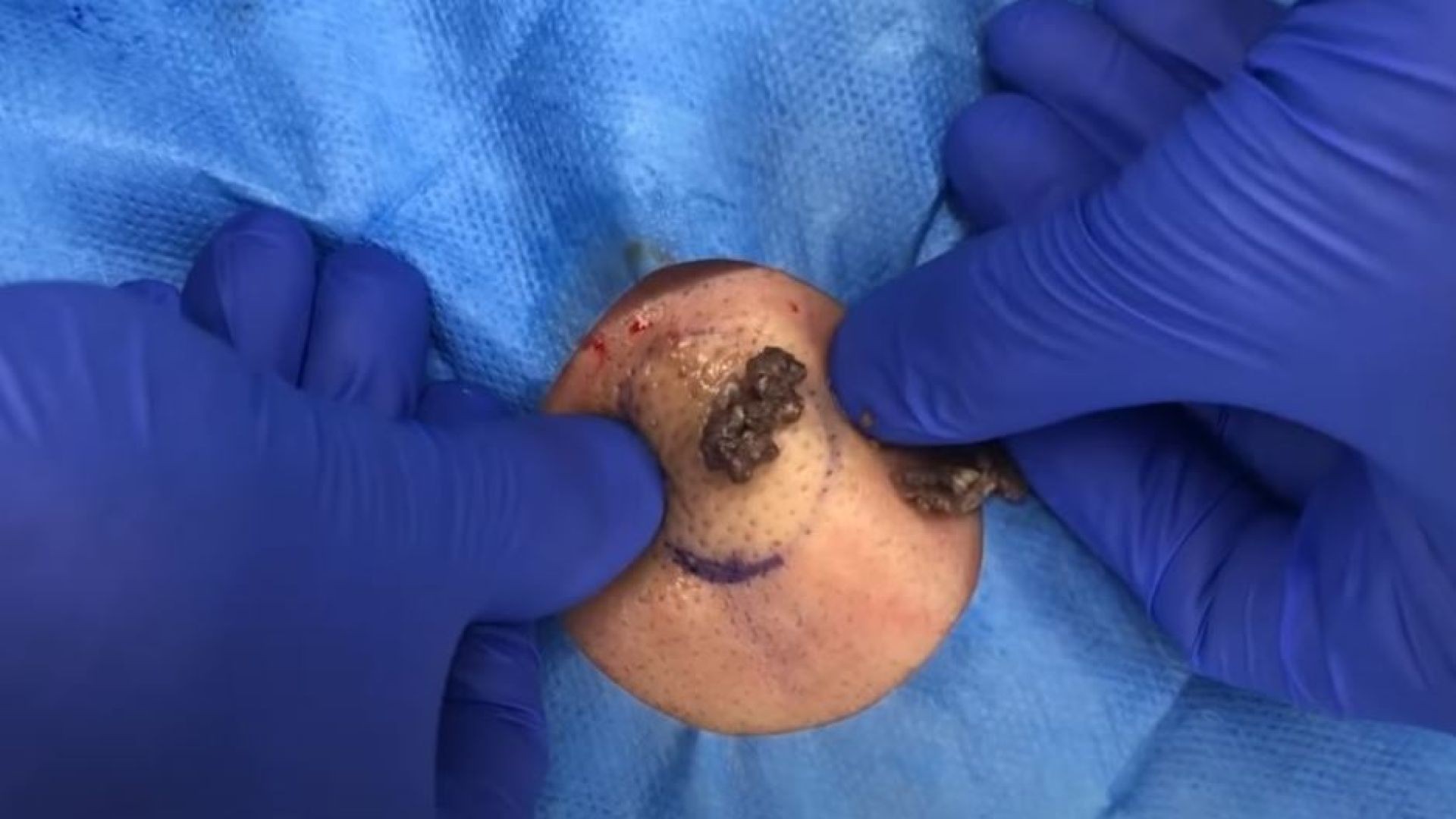 Cyst (Beluga Caviar) Extraction From Patient's Back