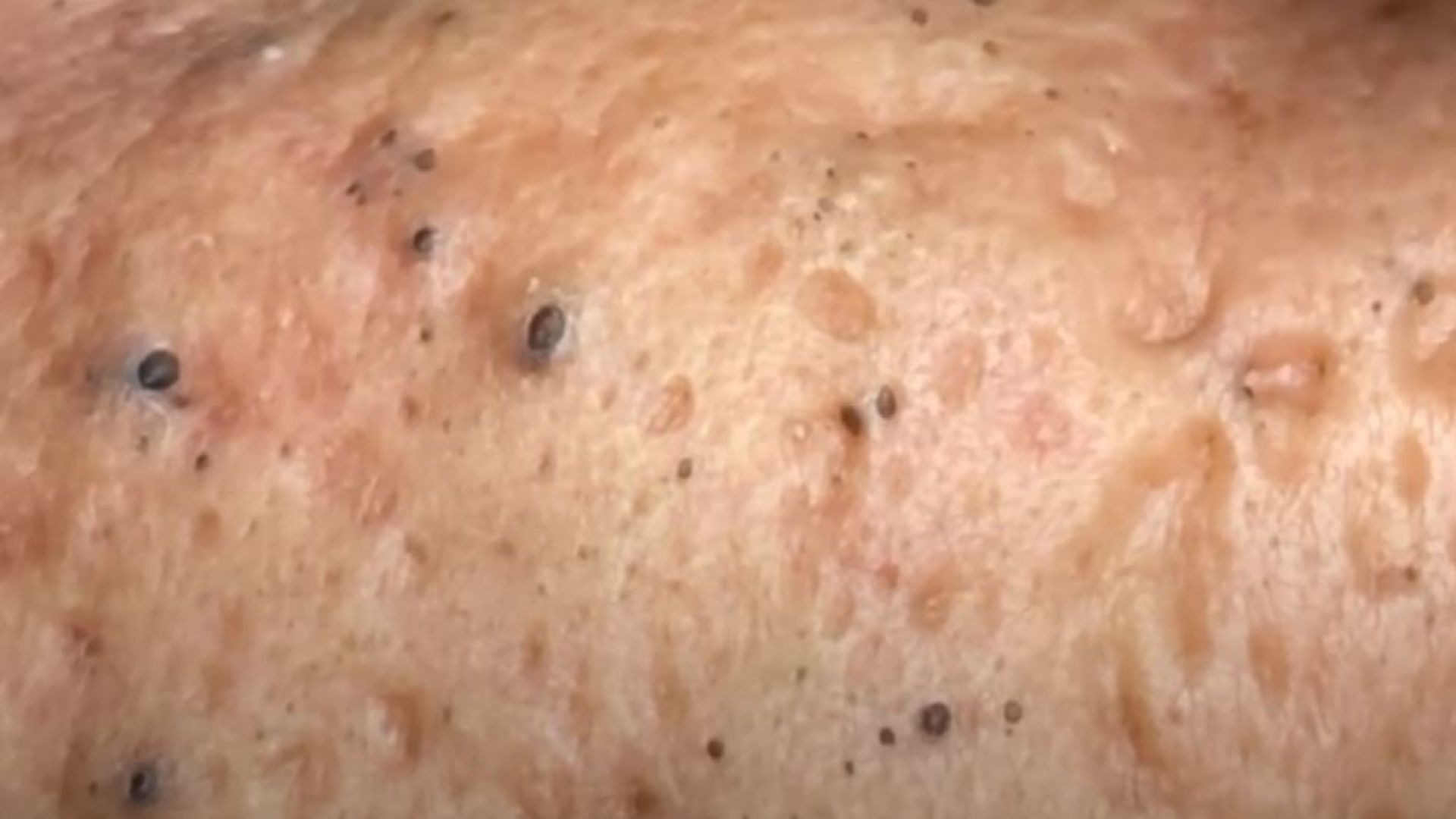Squeeze blackheads (perennial) 50 years around the ear part 2 @Quyet Tran Official