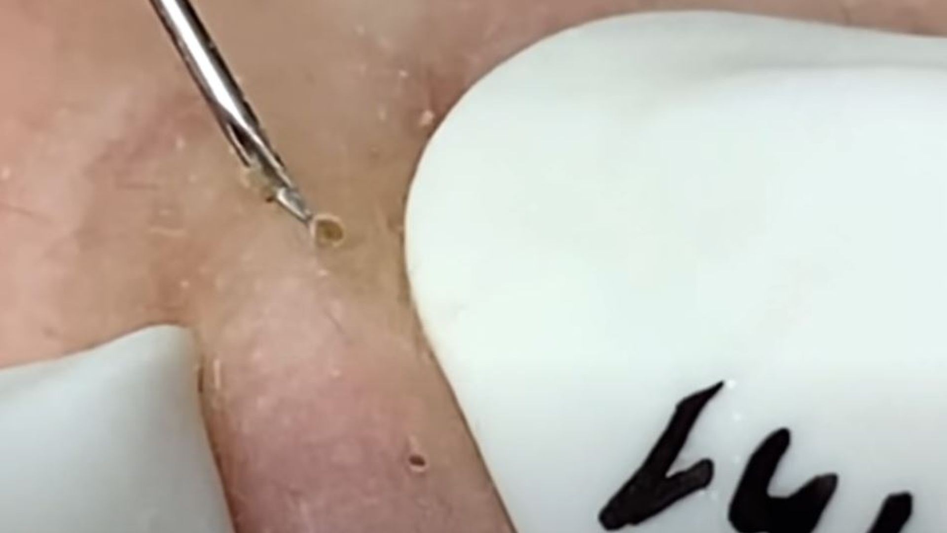 Removing Blackheads from nose Fast and Professionally