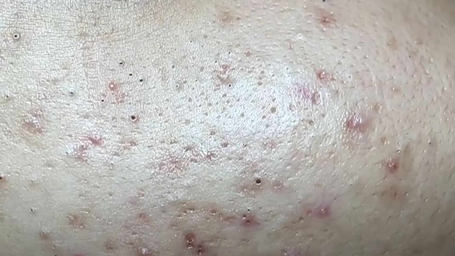 Treatment Of Blackheads And Hidden Acne  #024