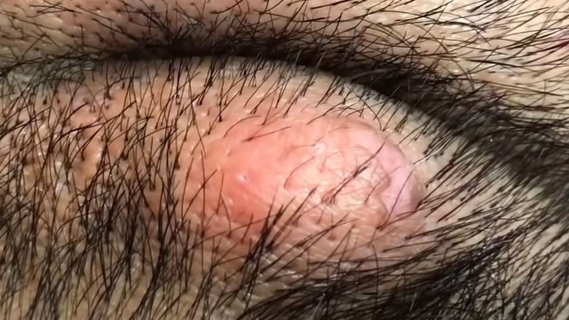 Giant cyst popping