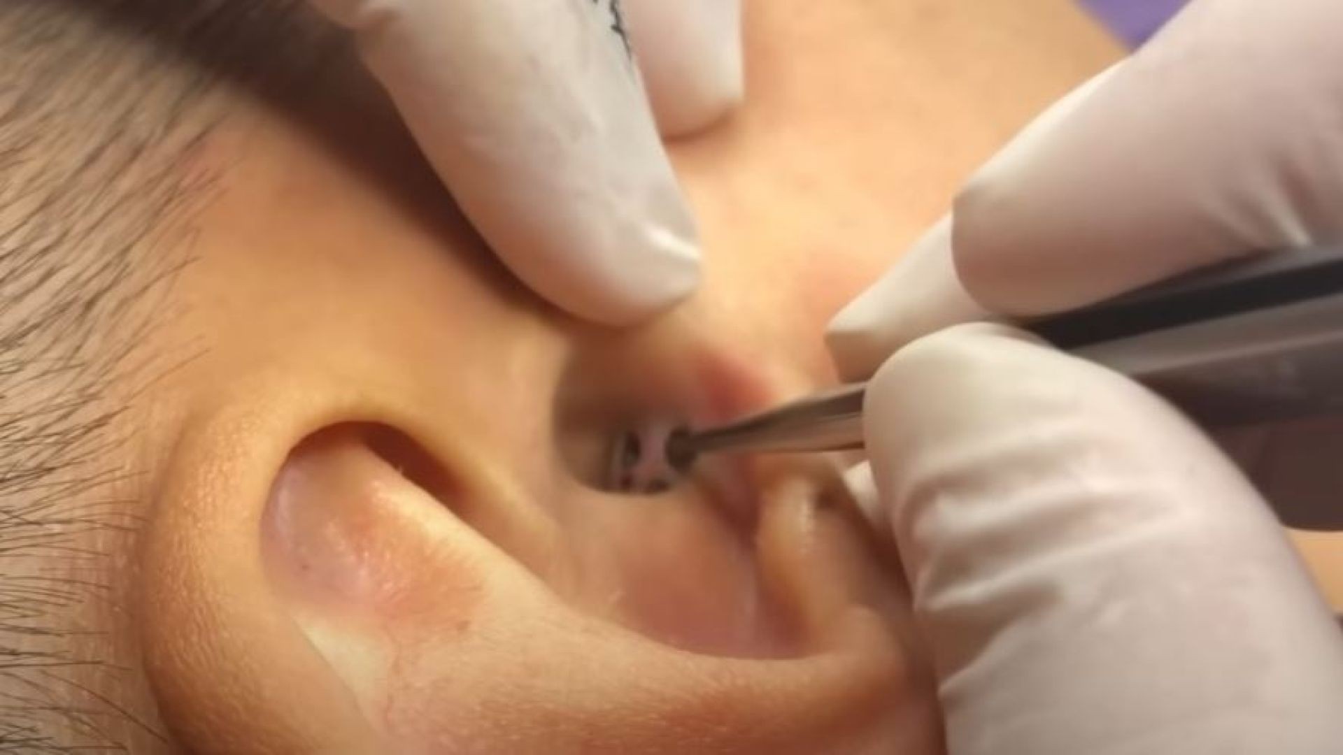 Three holes connected to blackheads