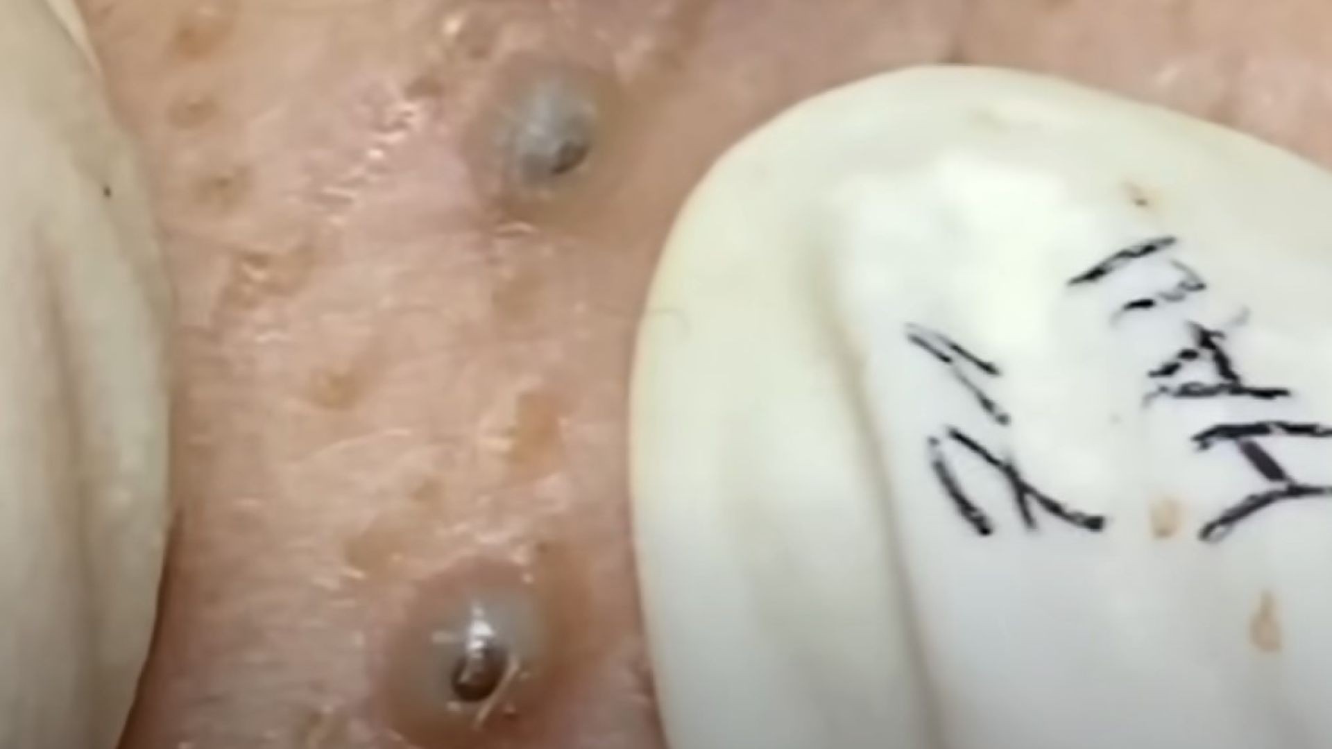 Blackhead cyst media - youtube