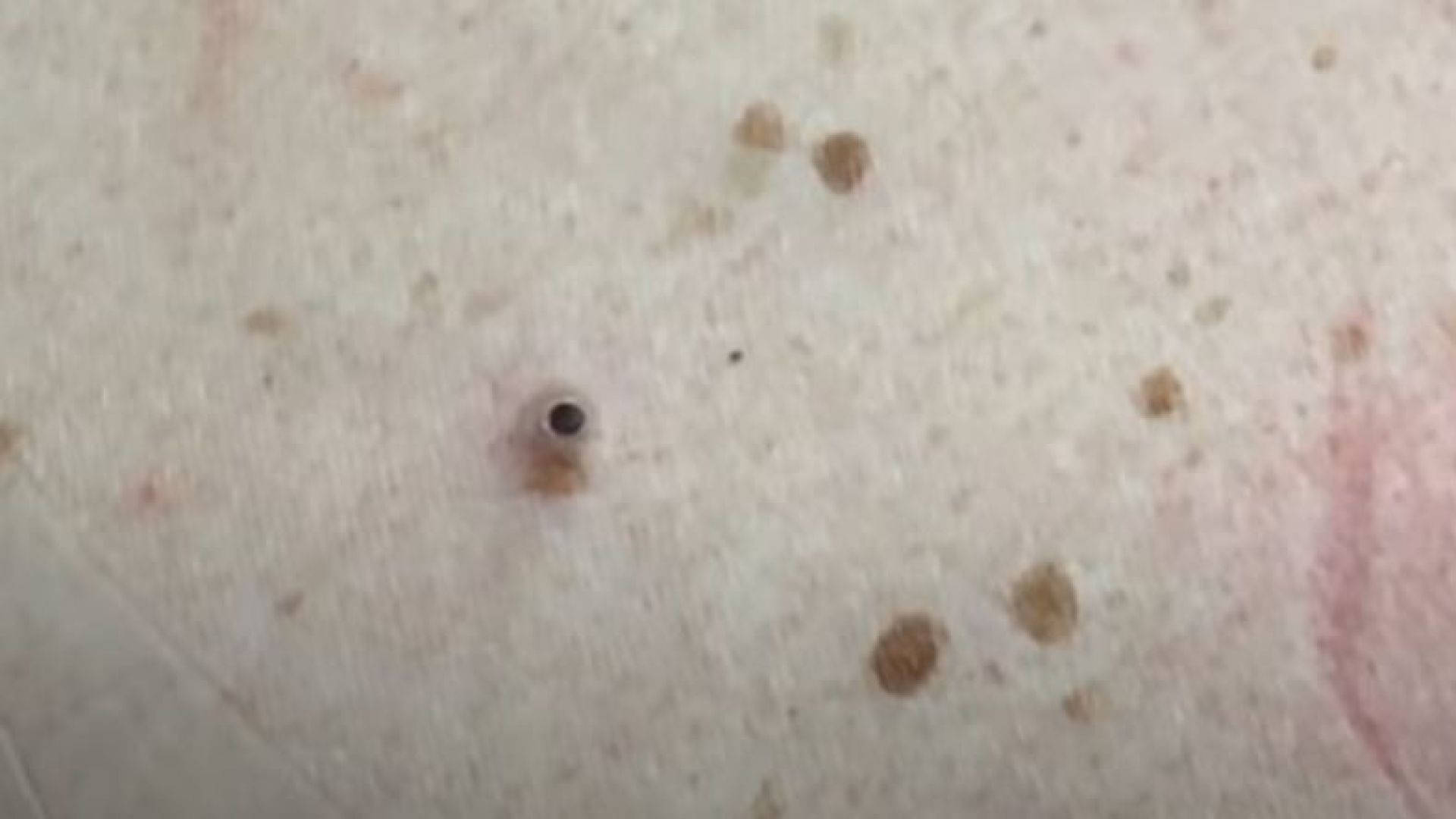 Double Decker's Dilated Pore