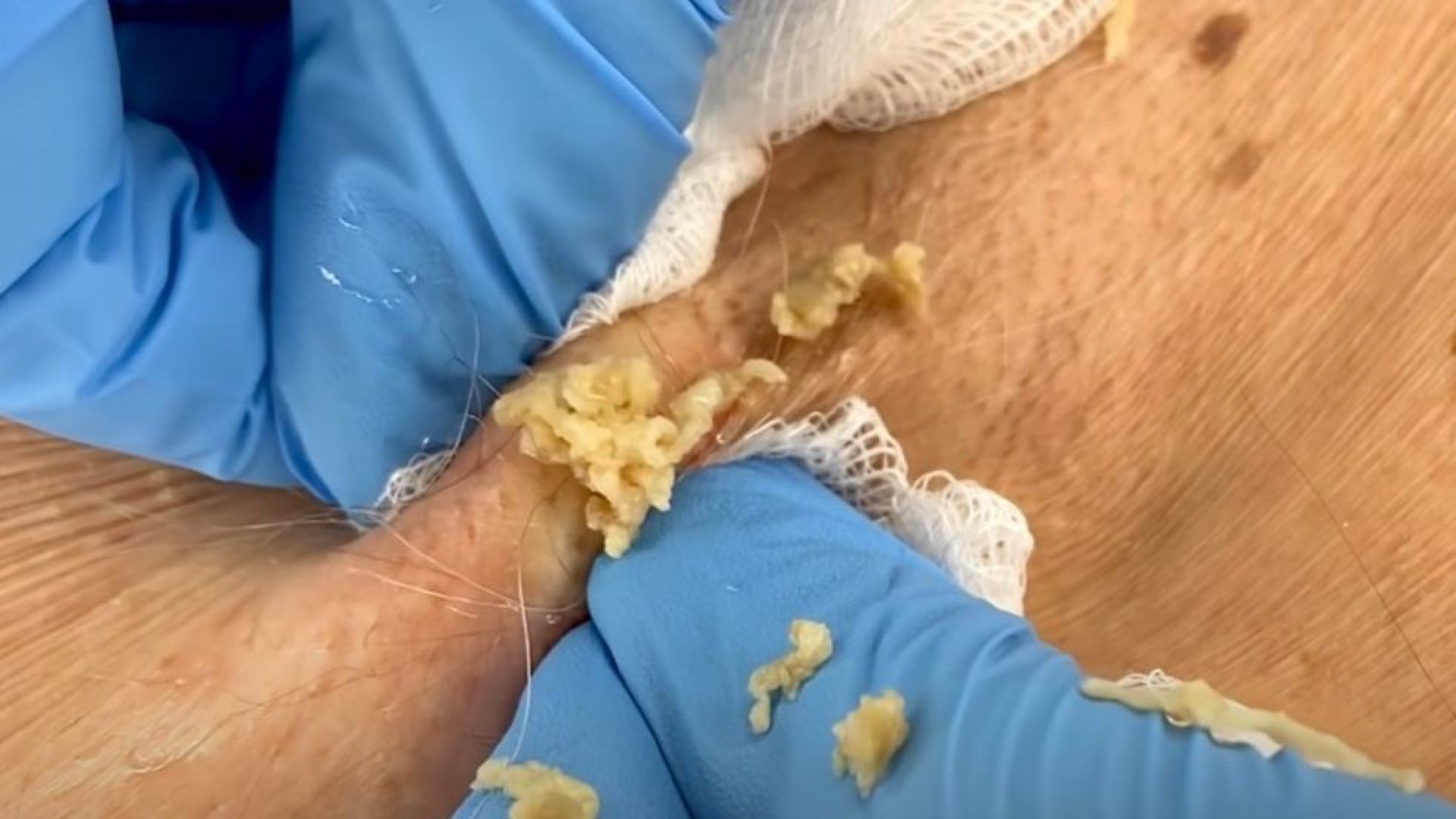 This Underarm Cyst is Like A Gift That Keeps Giving