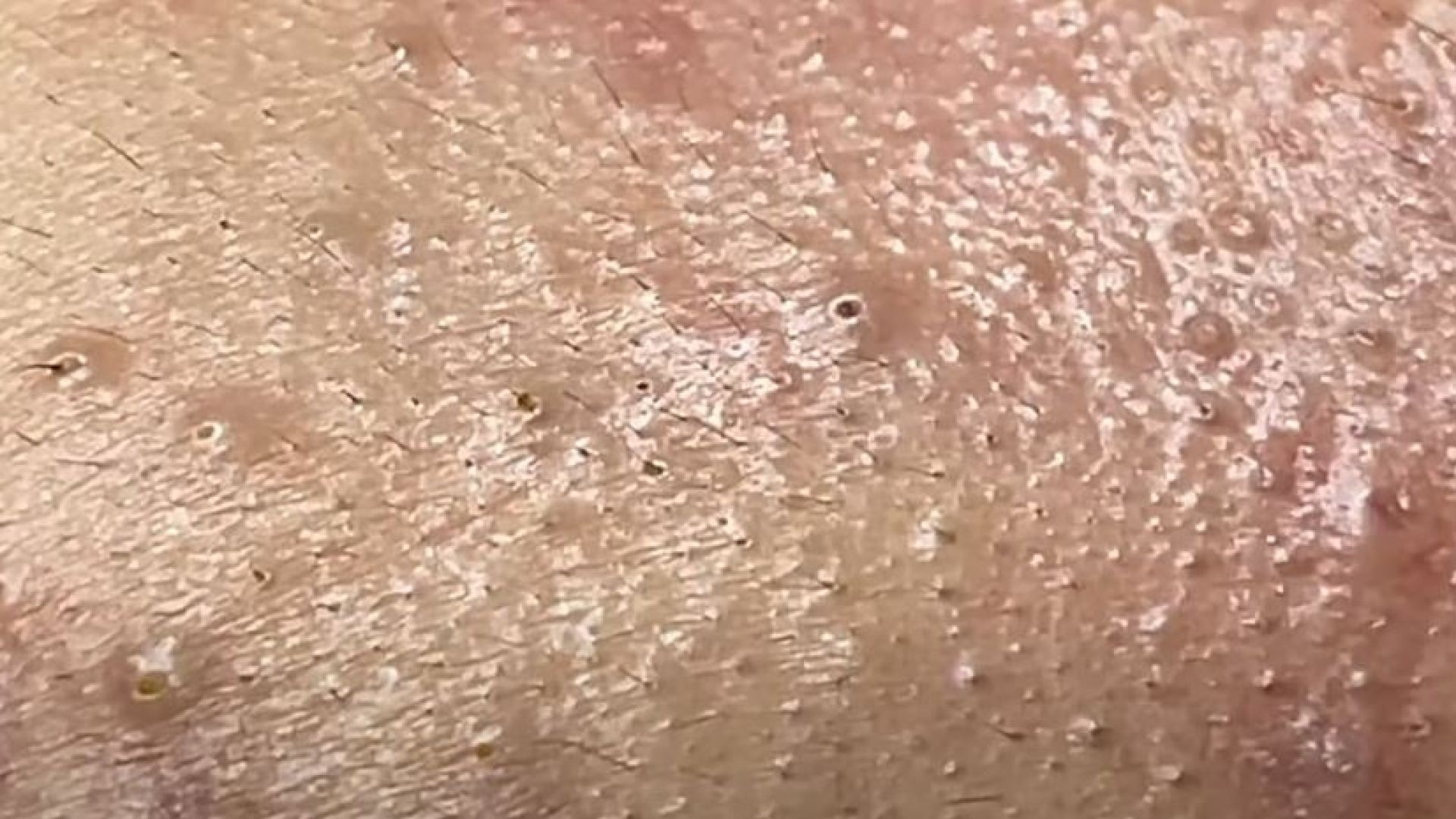 Treatment Of Blackheads and Hidden Acne on The Chin