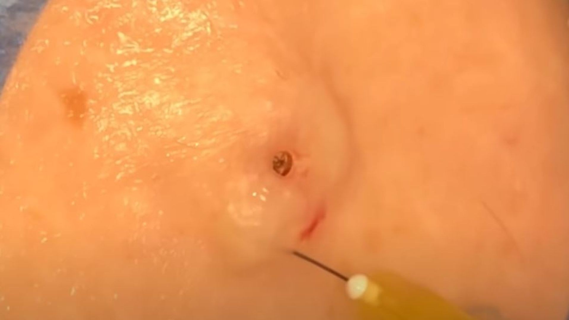Cyst Explodes Just Missing Camera, Doctor Works Hard to Extract it All!